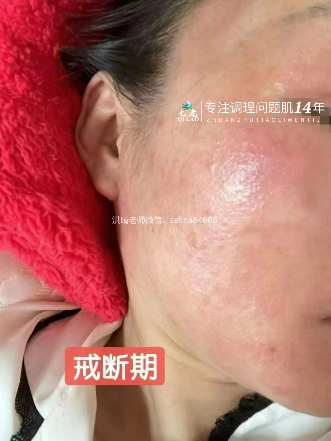 七老激素脸修护记录