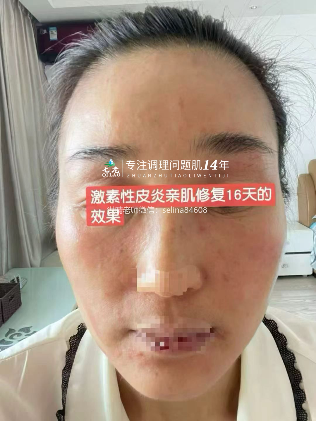 七老激素脸修护记录