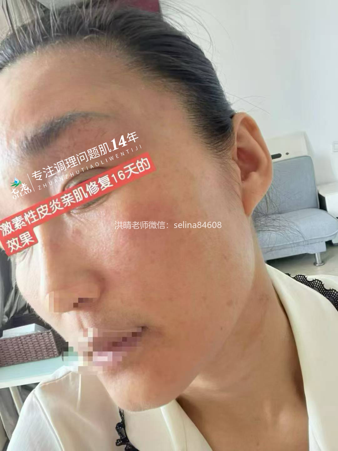 七老激素脸修护记录