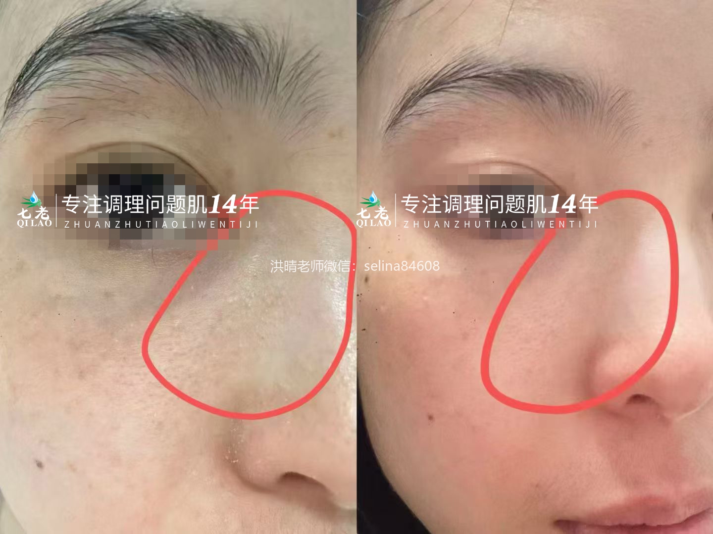 七老屏障受损修护2个月前面对比