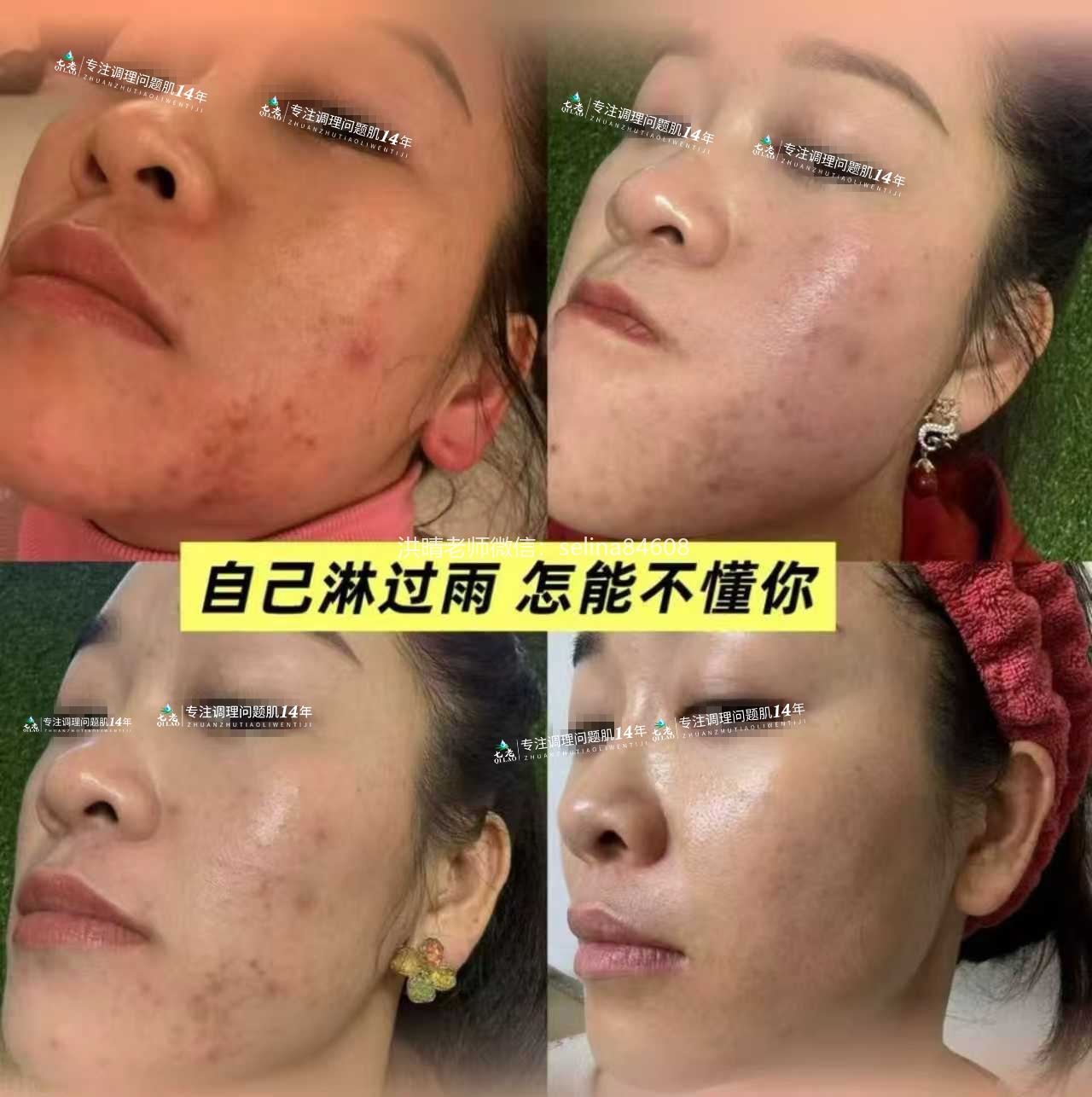 七老激素脸激素痘➕重度屏障受损修护案例