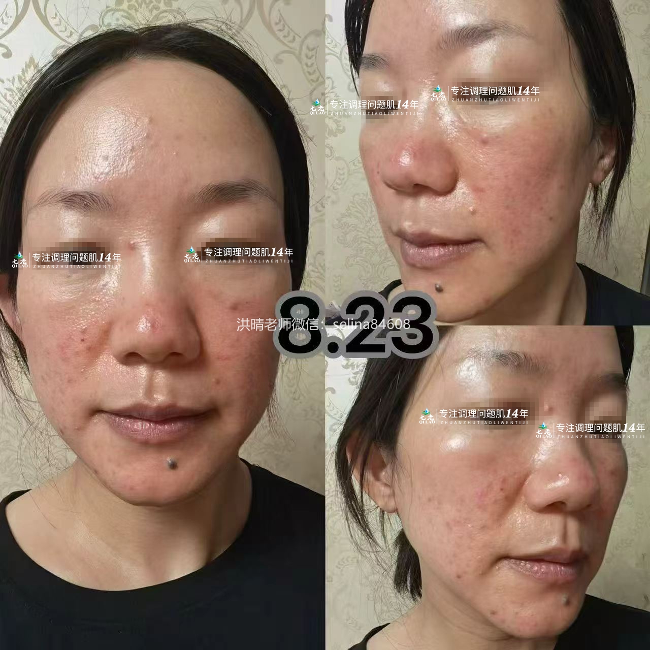 七老金线莲新品修护记录