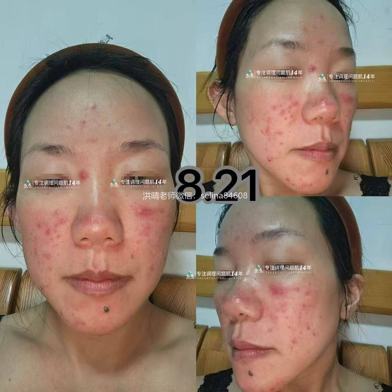 七老金线莲新品修护记录