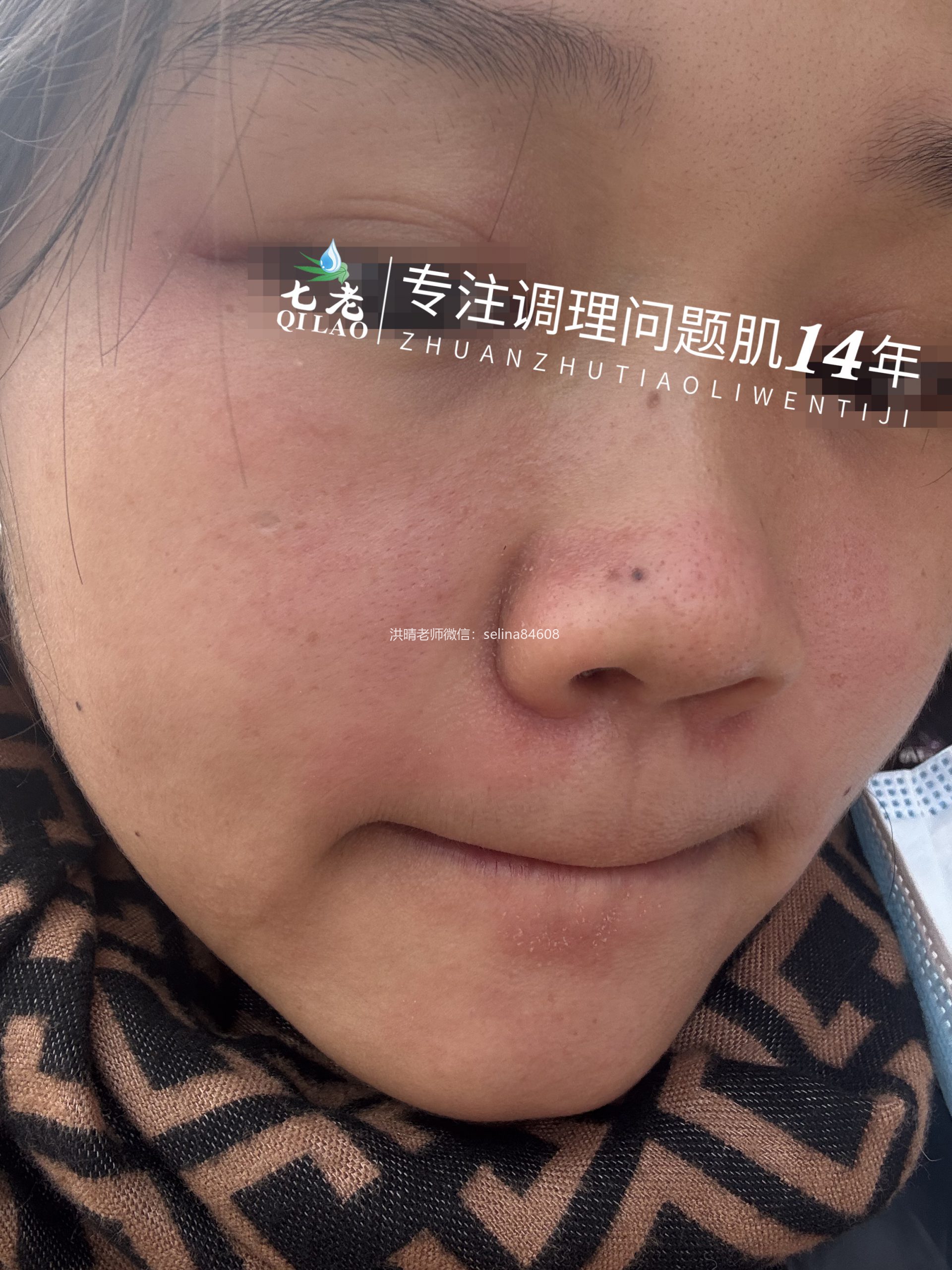 七老脂溢性皮炎修护案例