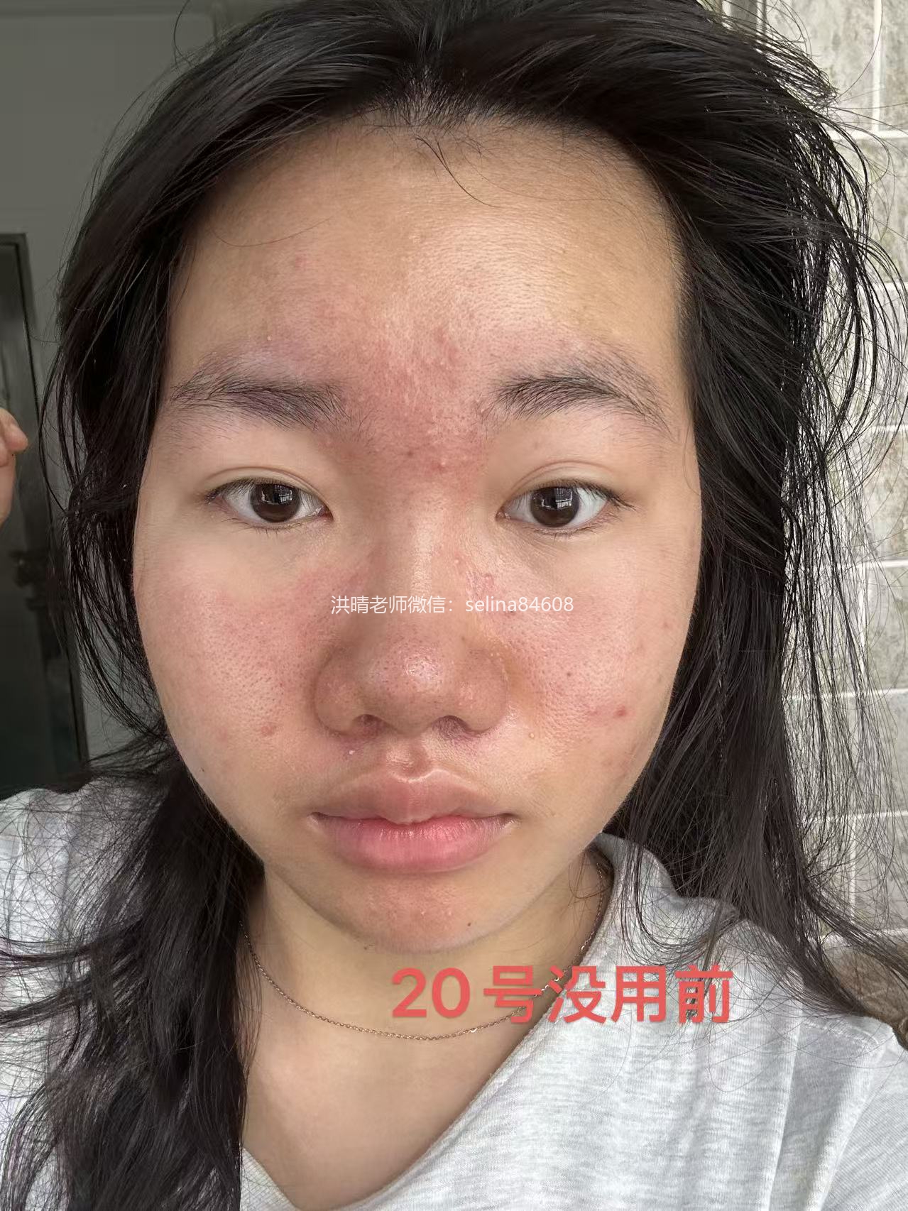 七老新品预告→金线莲系列针对顽固痘痘玫瑰痤疮，脂溢性皮炎，油敏疹子痘痘肌