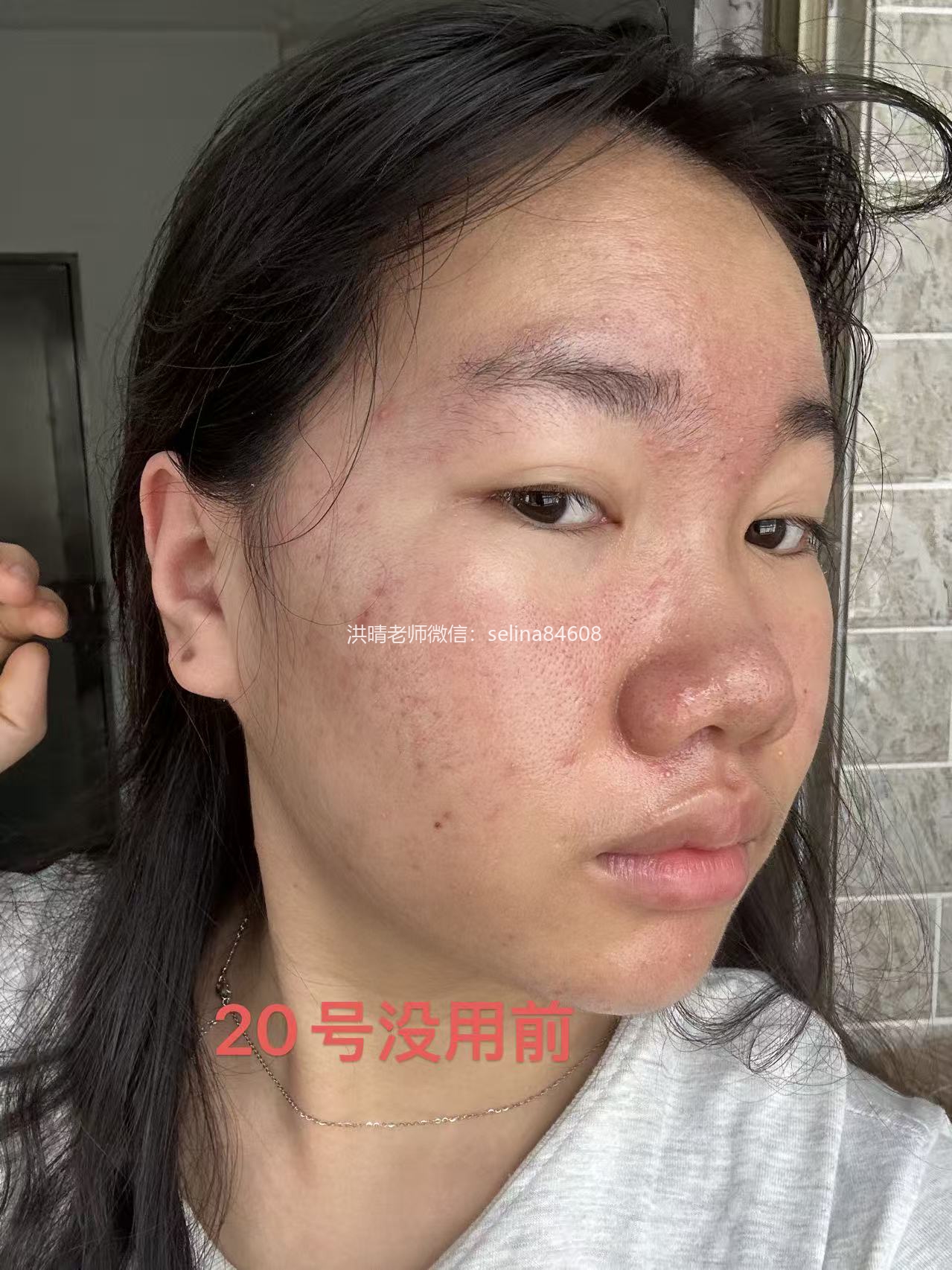 七老新品预告→金线莲系列针对顽固痘痘玫瑰痤疮，脂溢性皮炎，油敏疹子痘痘肌