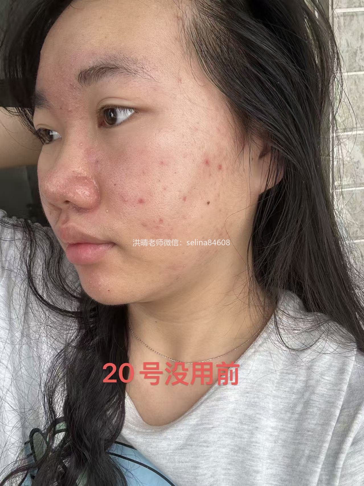 七老新品预告→金线莲系列针对顽固痘痘玫瑰痤疮，脂溢性皮炎，油敏疹子痘痘肌