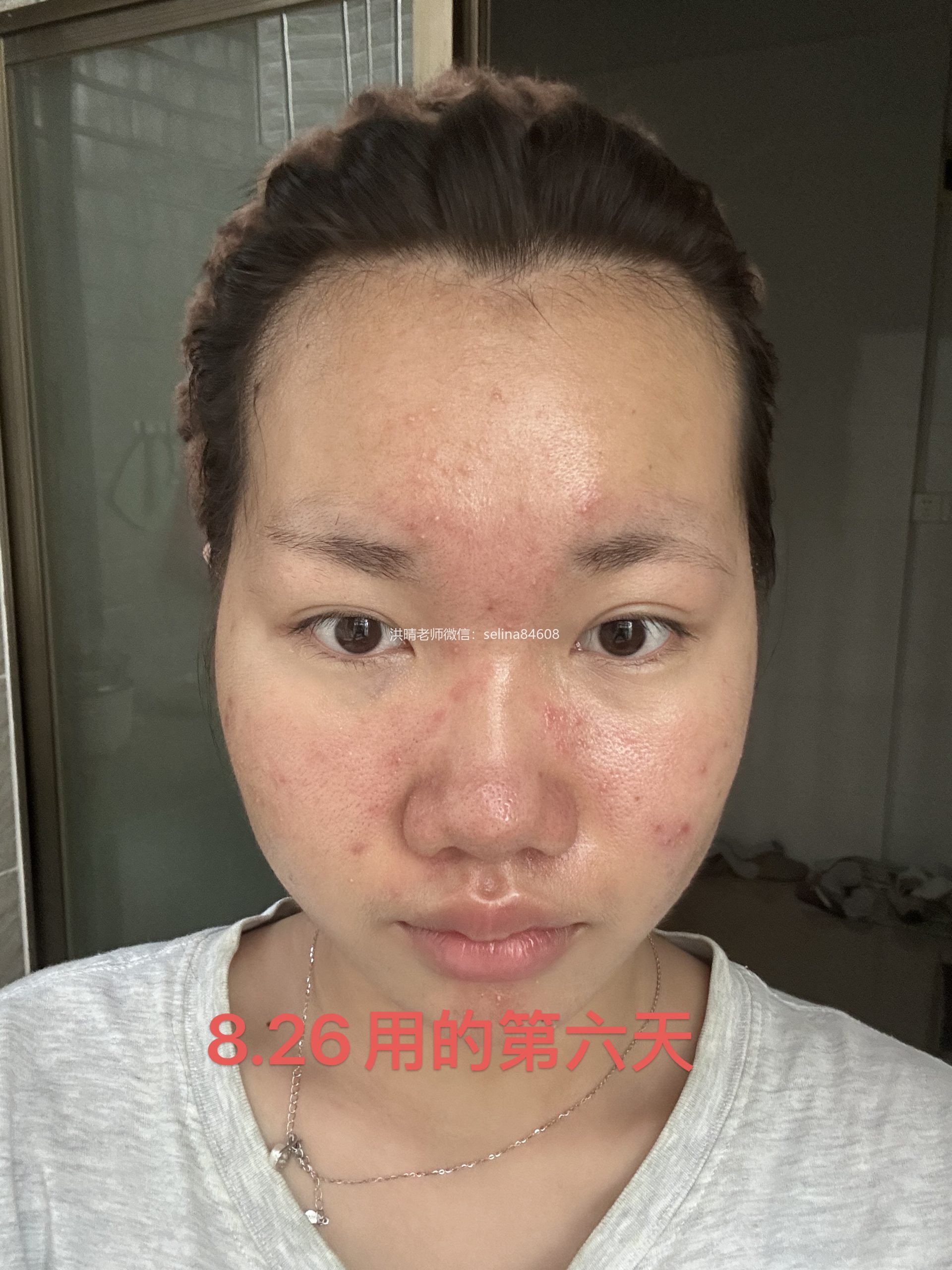 七老新品预告→金线莲系列针对顽固痘痘玫瑰痤疮，脂溢性皮炎，油敏疹子痘痘肌