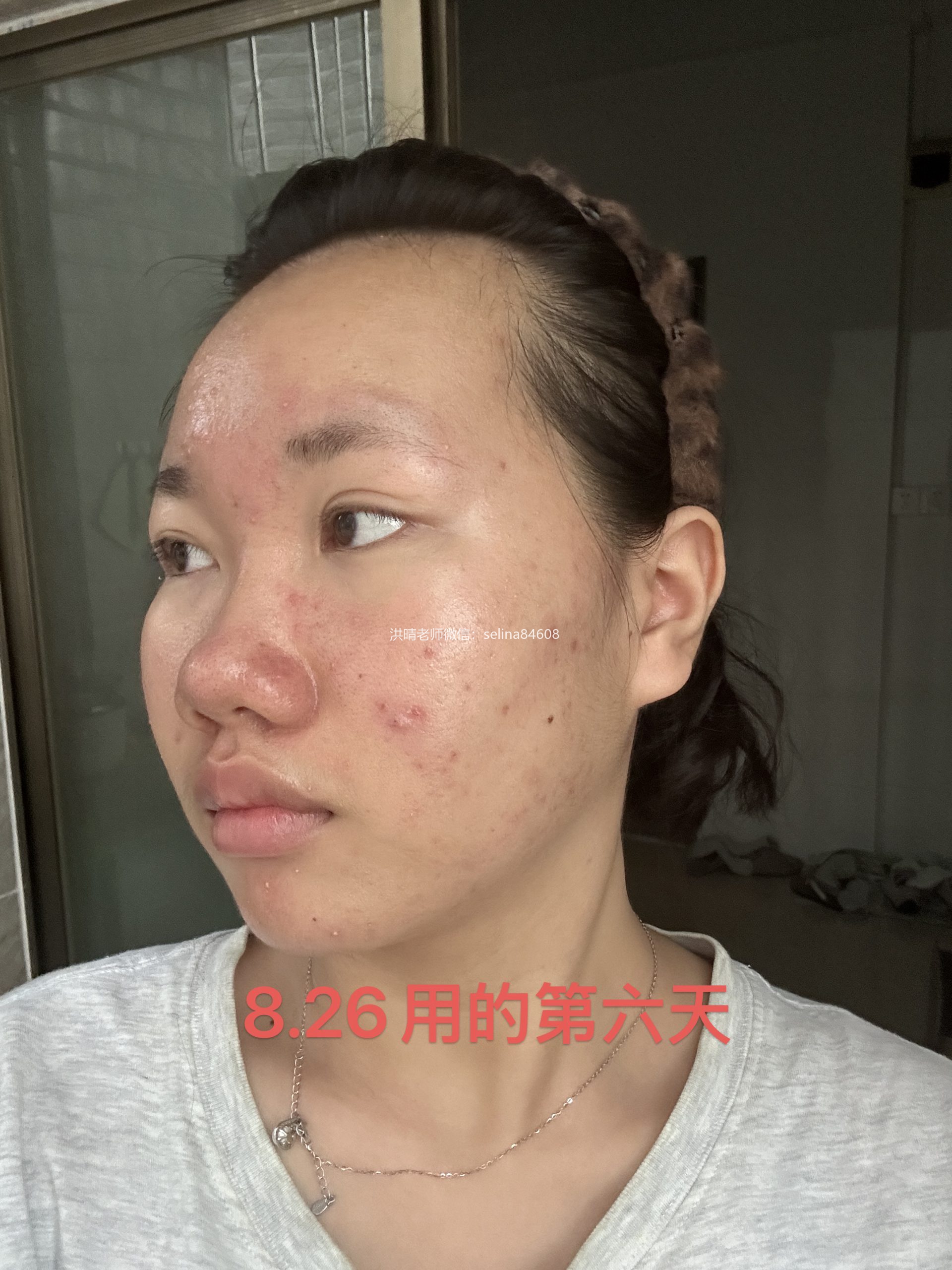 七老新品预告→金线莲系列针对顽固痘痘玫瑰痤疮，脂溢性皮炎，油敏疹子痘痘肌