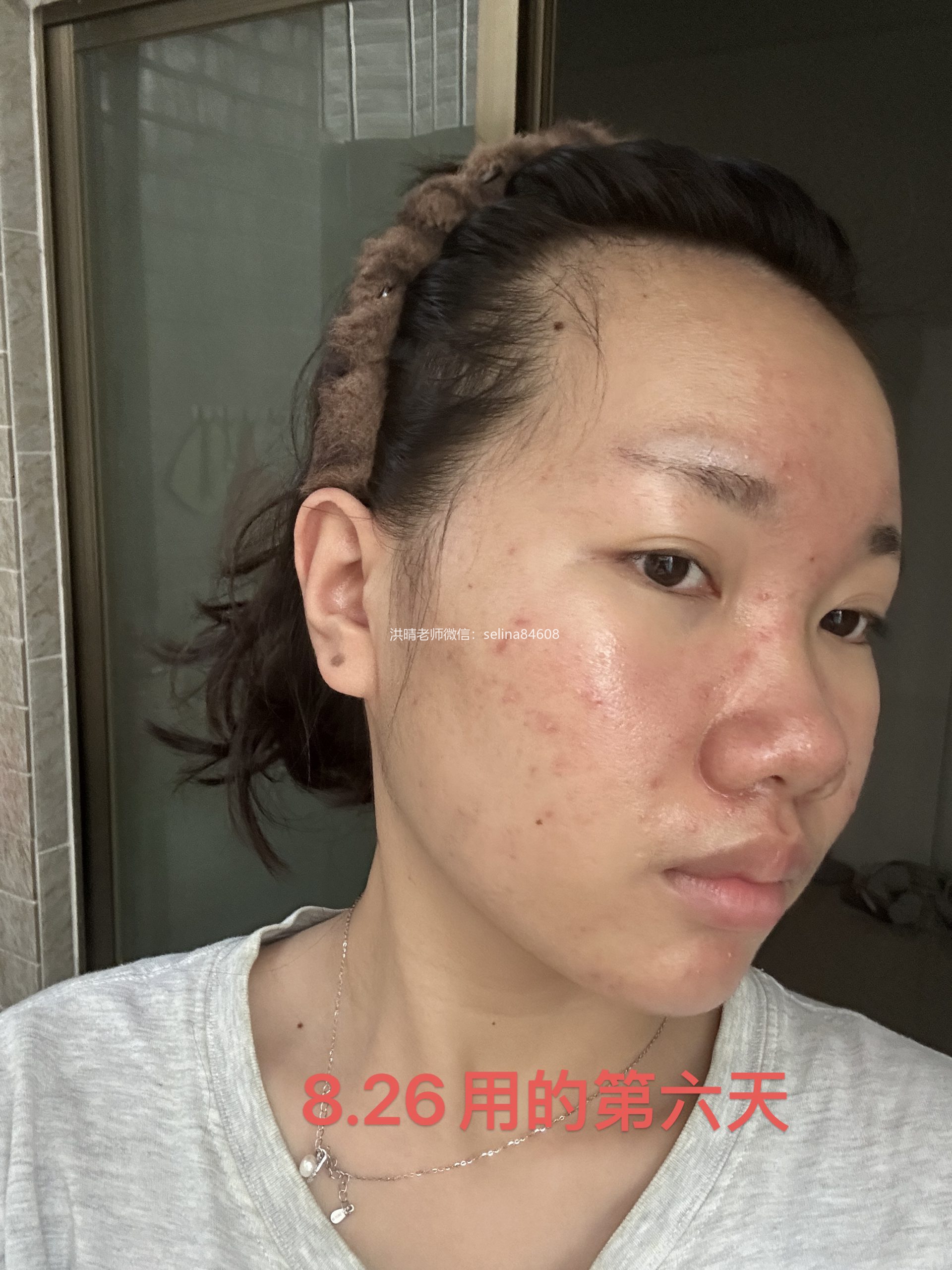 七老新品预告→金线莲系列针对顽固痘痘玫瑰痤疮，脂溢性皮炎，油敏疹子痘痘肌