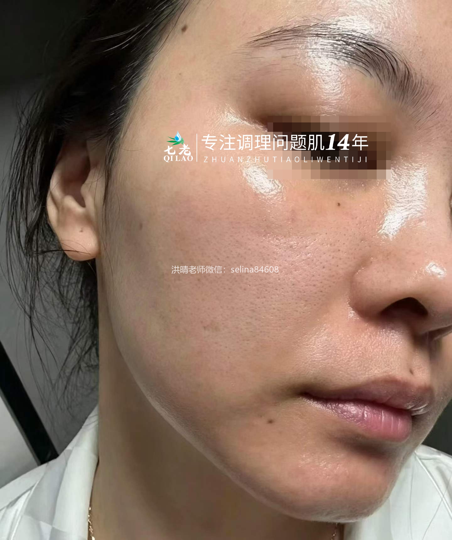 七老油敏疹子修护案例好评反馈