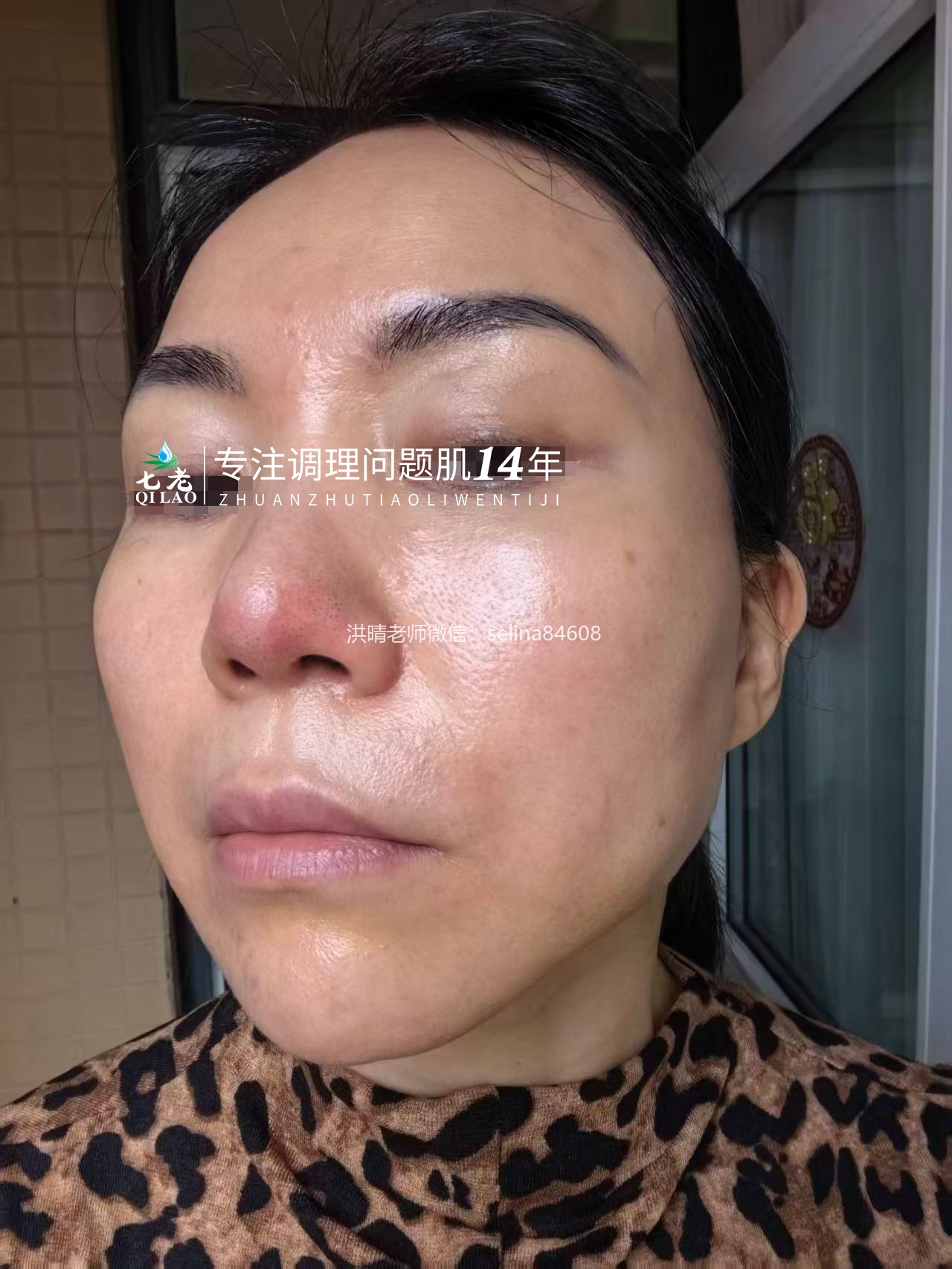 七老屏障受损油敏肌玫瑰痤疮修护案例