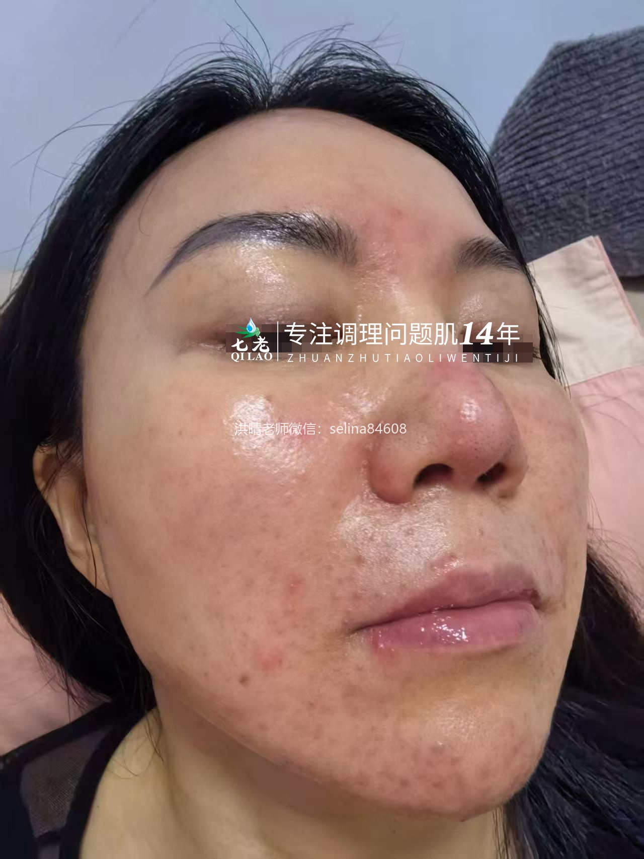 七老屏障受损油敏肌玫瑰痤疮修护案例