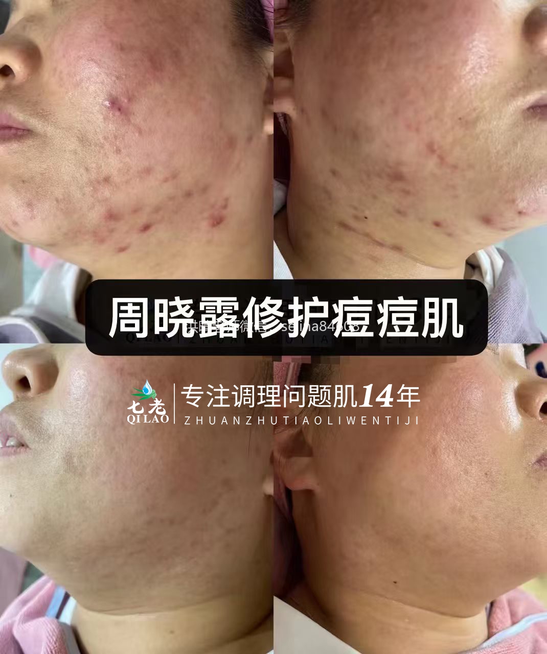 七老反复泛红长痘修护案例