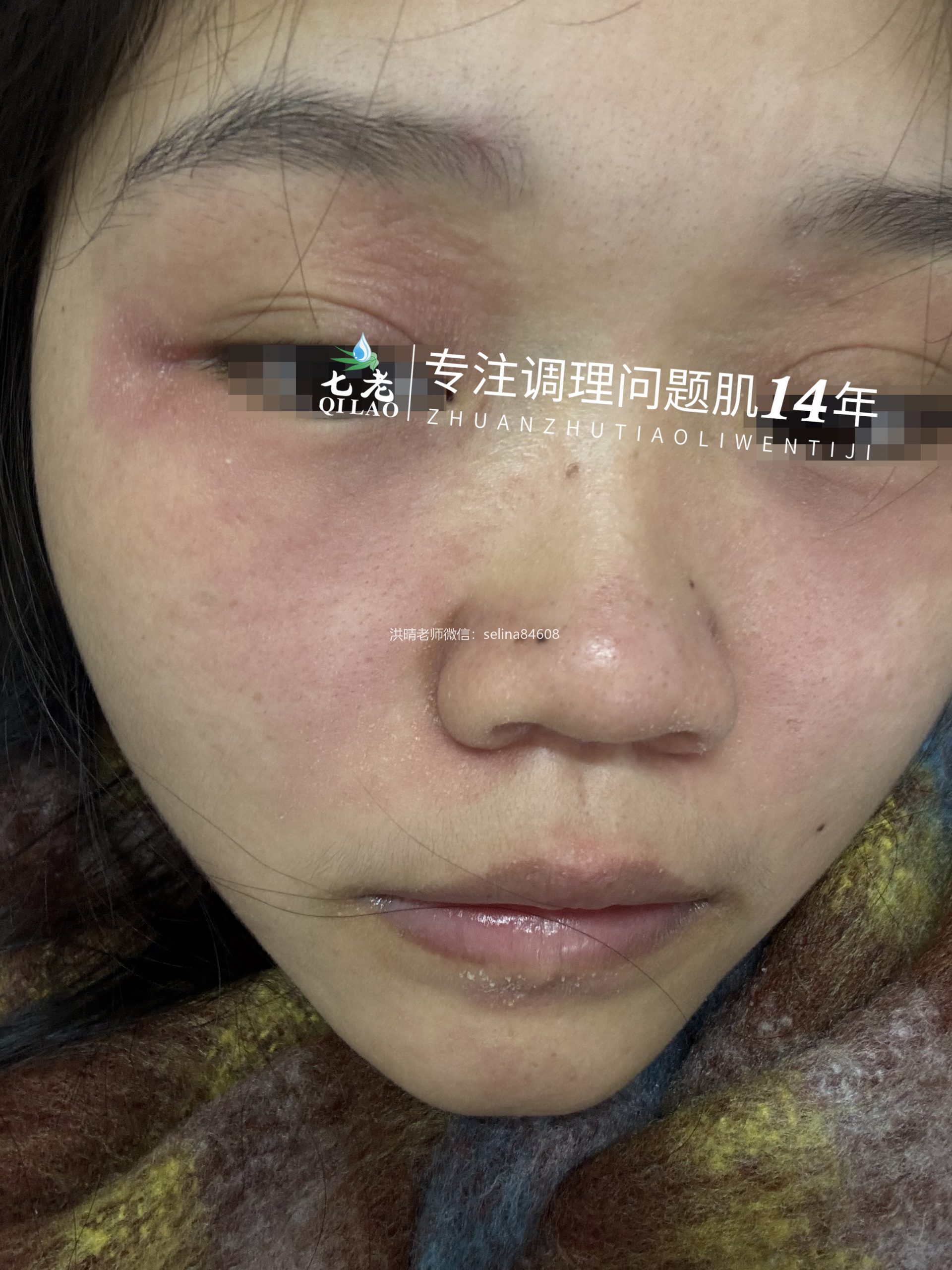 七老脂溢性皮炎修护案例