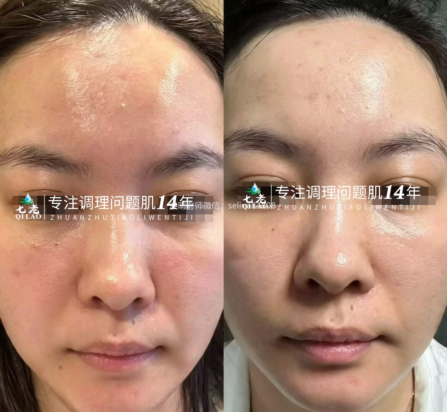 七老油敏疹子修护案例好评反馈