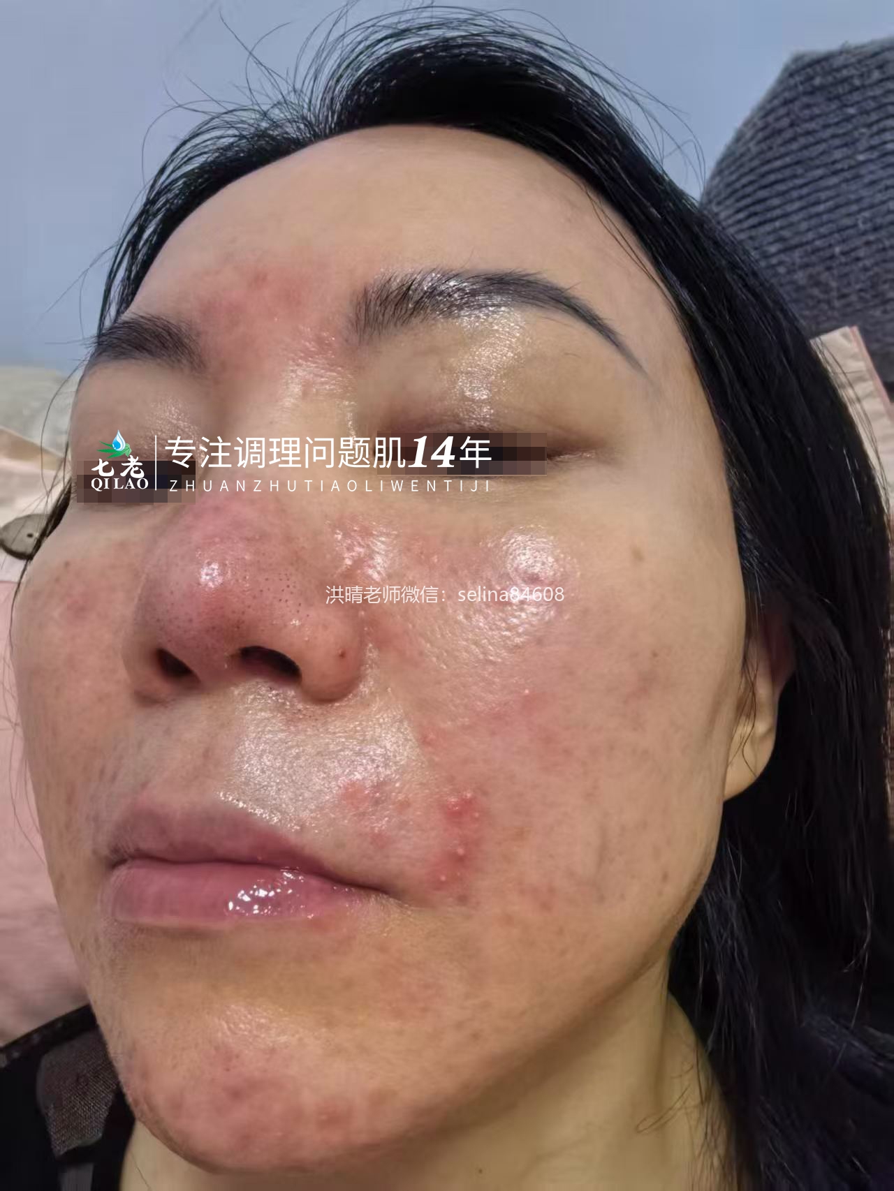 七老屏障受损油敏肌玫瑰痤疮修护案例