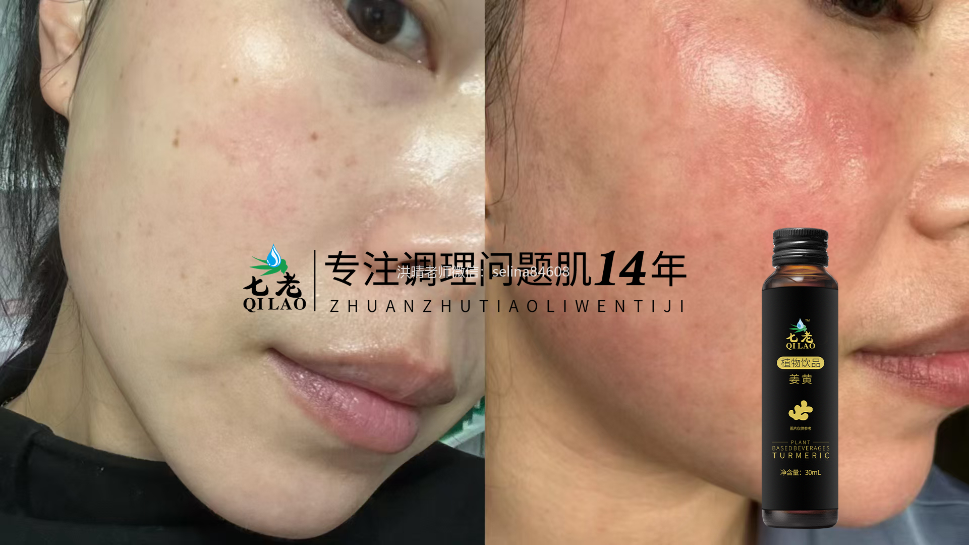 七老姜黄抗炎饮，疹子痘痘反复过敏红痒，慢性炎症和姐妹喝起来