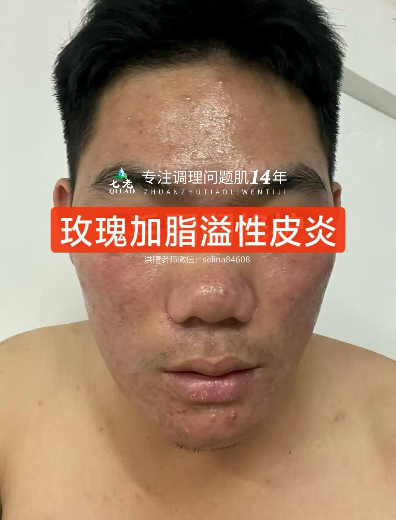七老玫瑰痤疮➕脂溢性皮炎修护案例