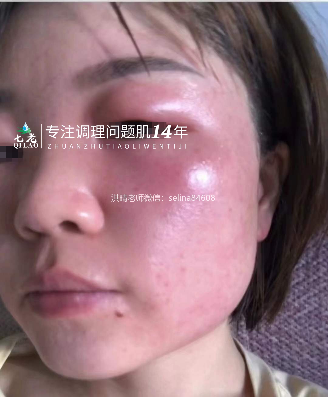 七老激素脸➕脂皮修护案例