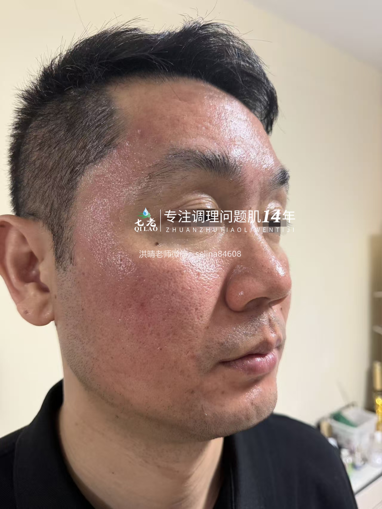 七老十年顽固痘痘肌修护案例
