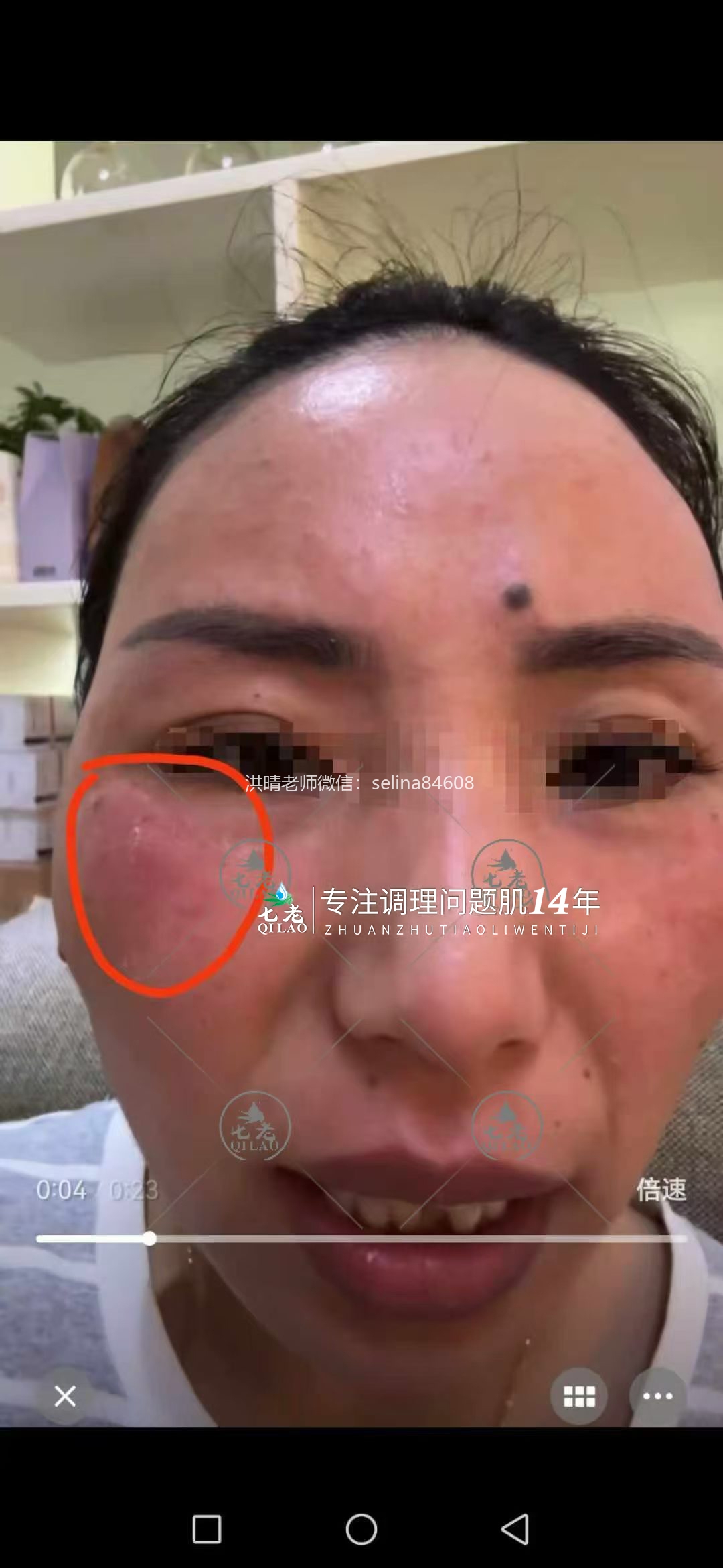 七老激素脸发红发烫修护案例
