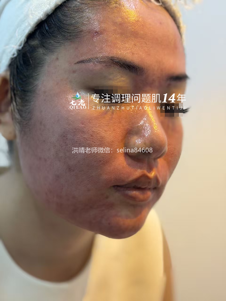 七老激素脸激素痘修护案例