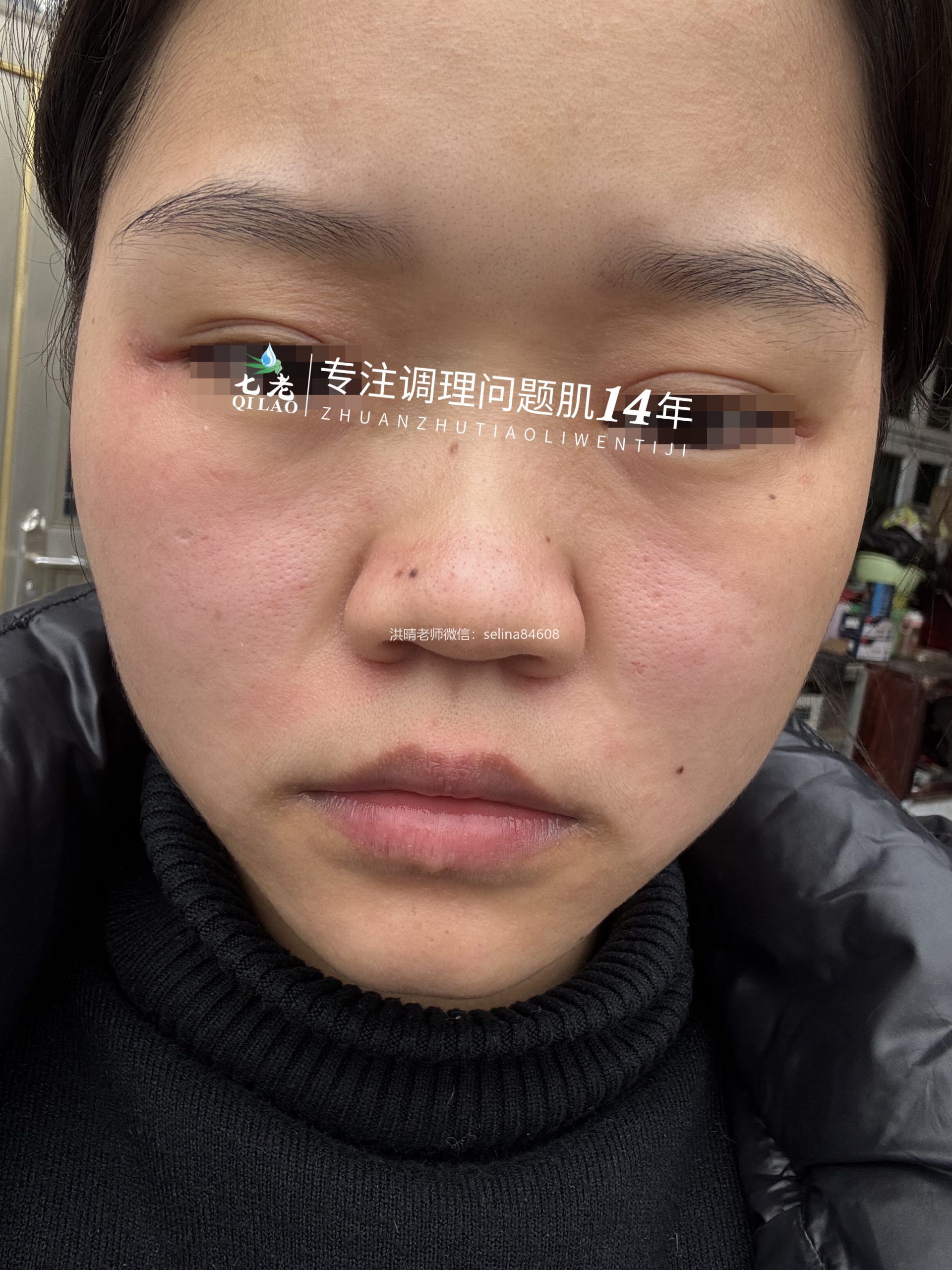 七老脂溢性皮炎修护案例
