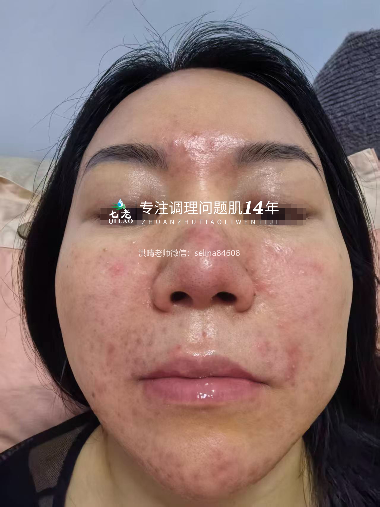 七老屏障受损油敏肌玫瑰痤疮修护案例