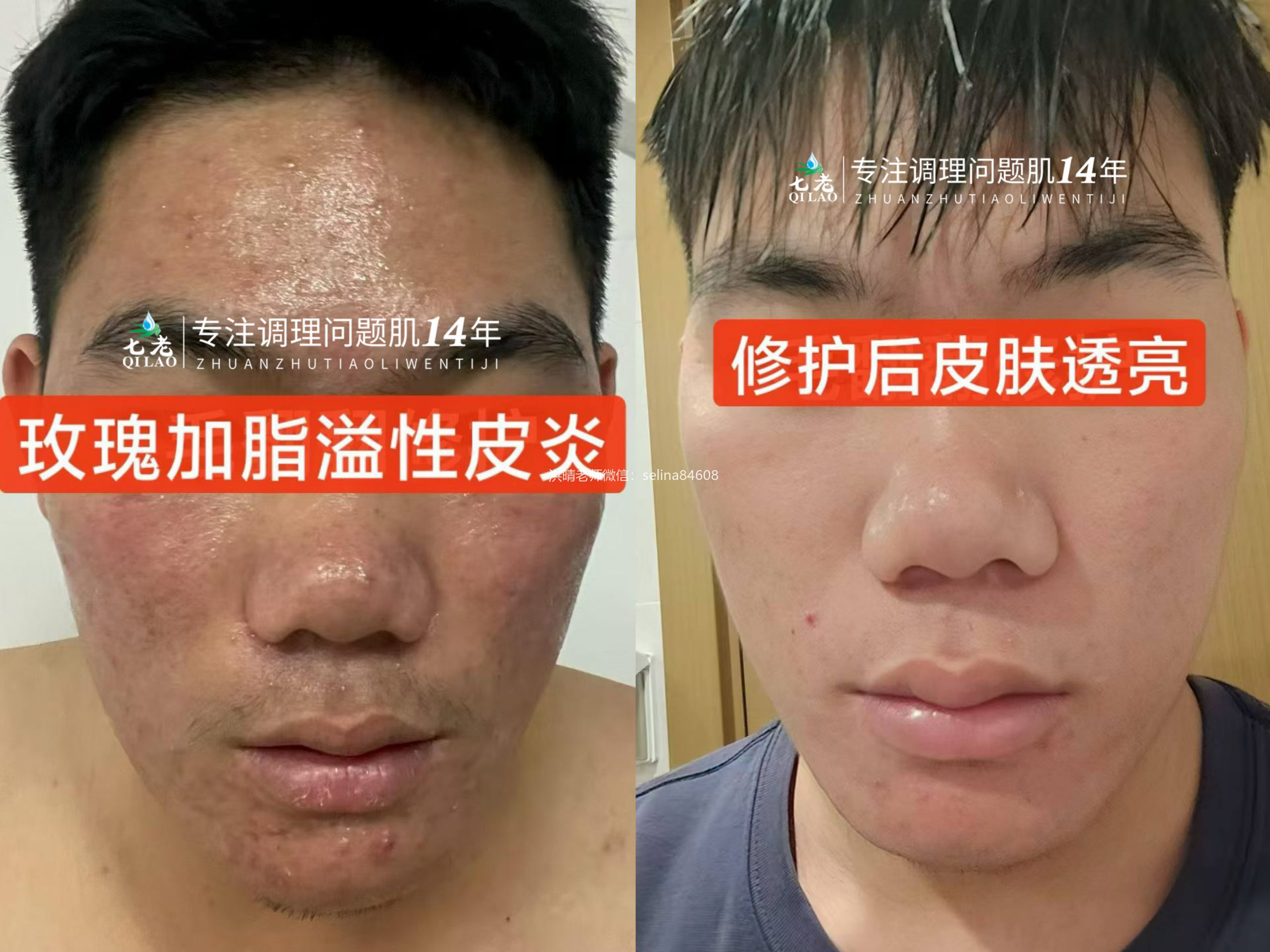 七老玫瑰痤疮➕脂溢性皮炎修护案例