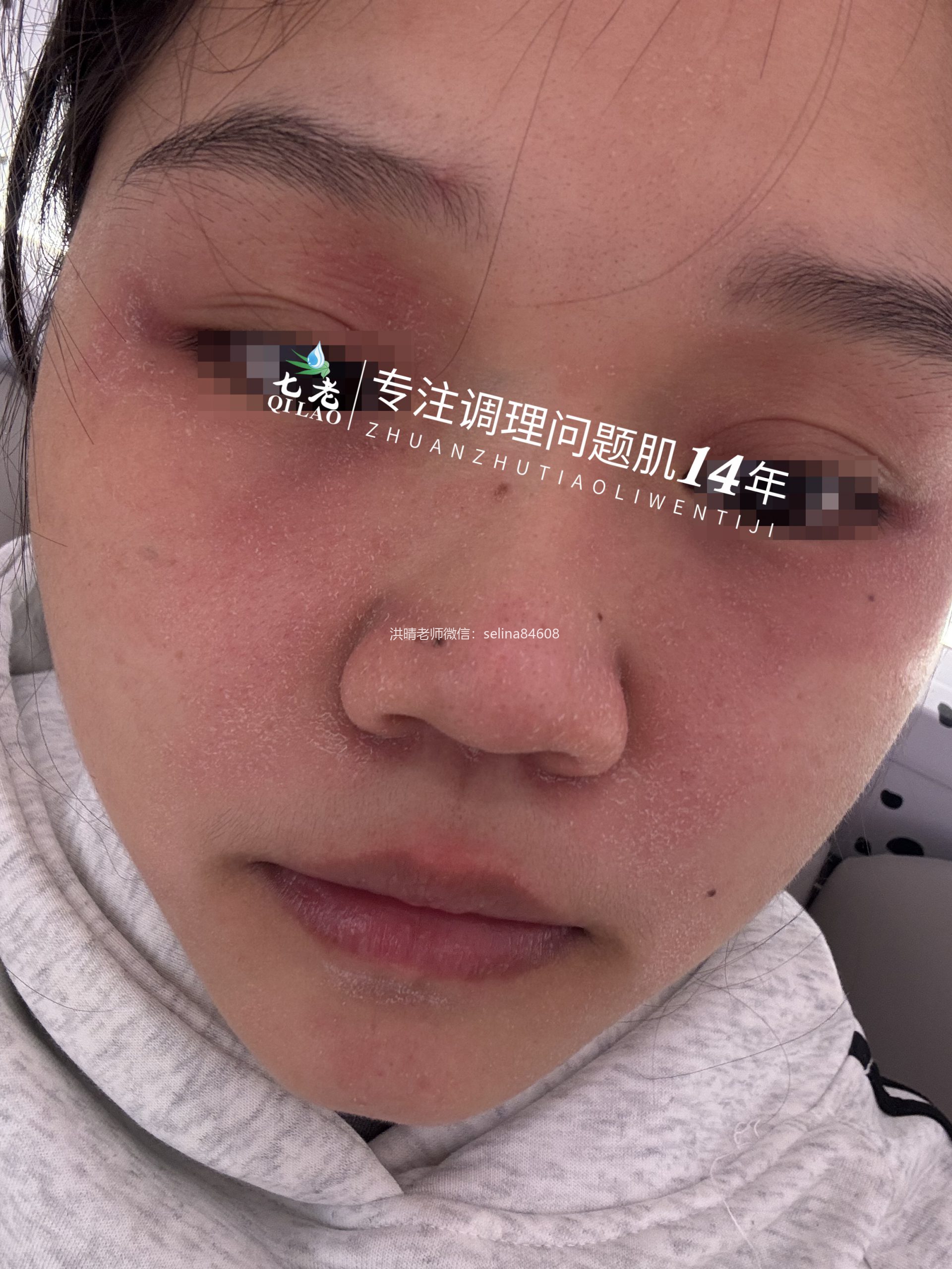 七老脂溢性皮炎修护案例