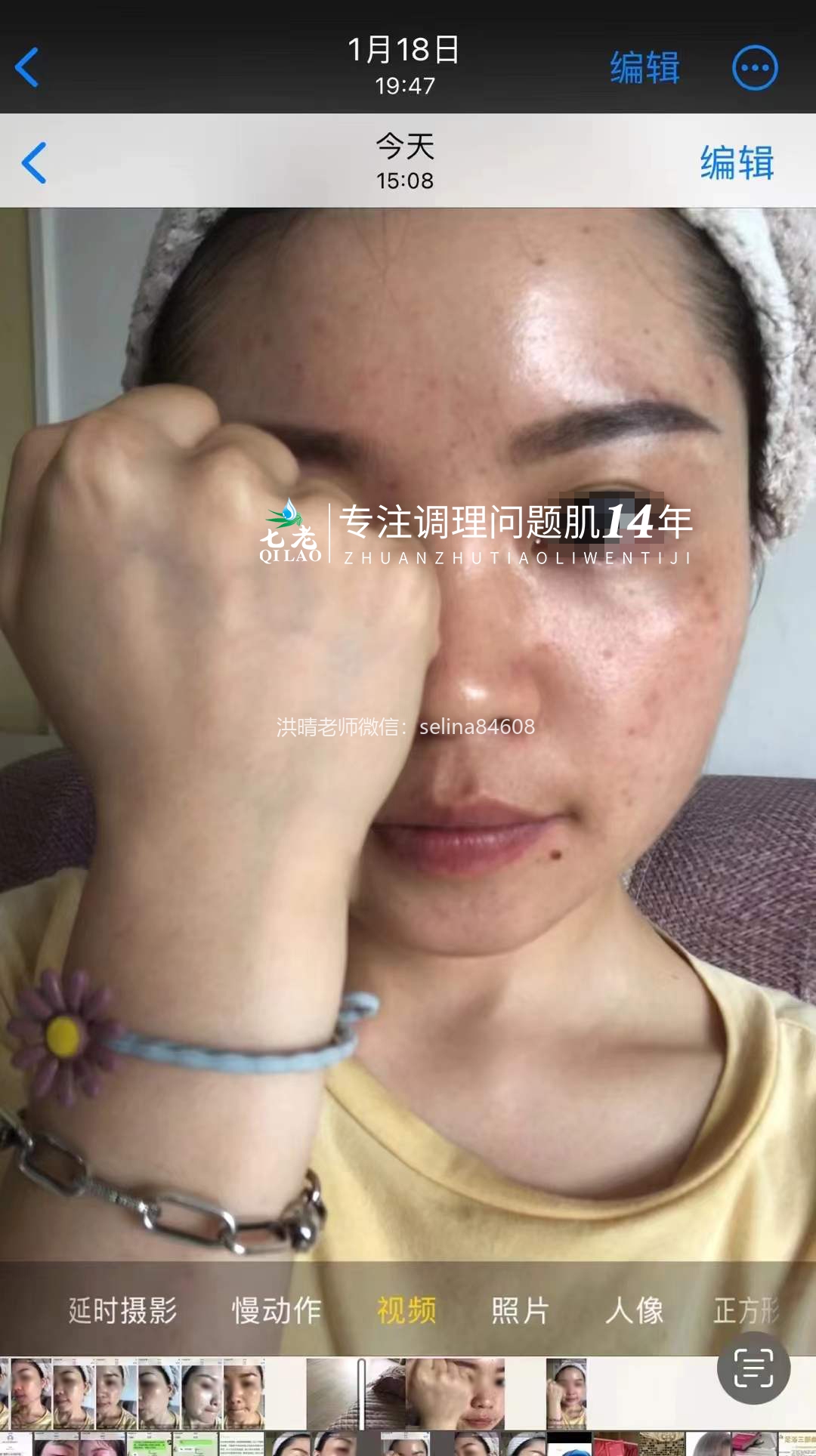 七老激素脸➕脂皮修护案例