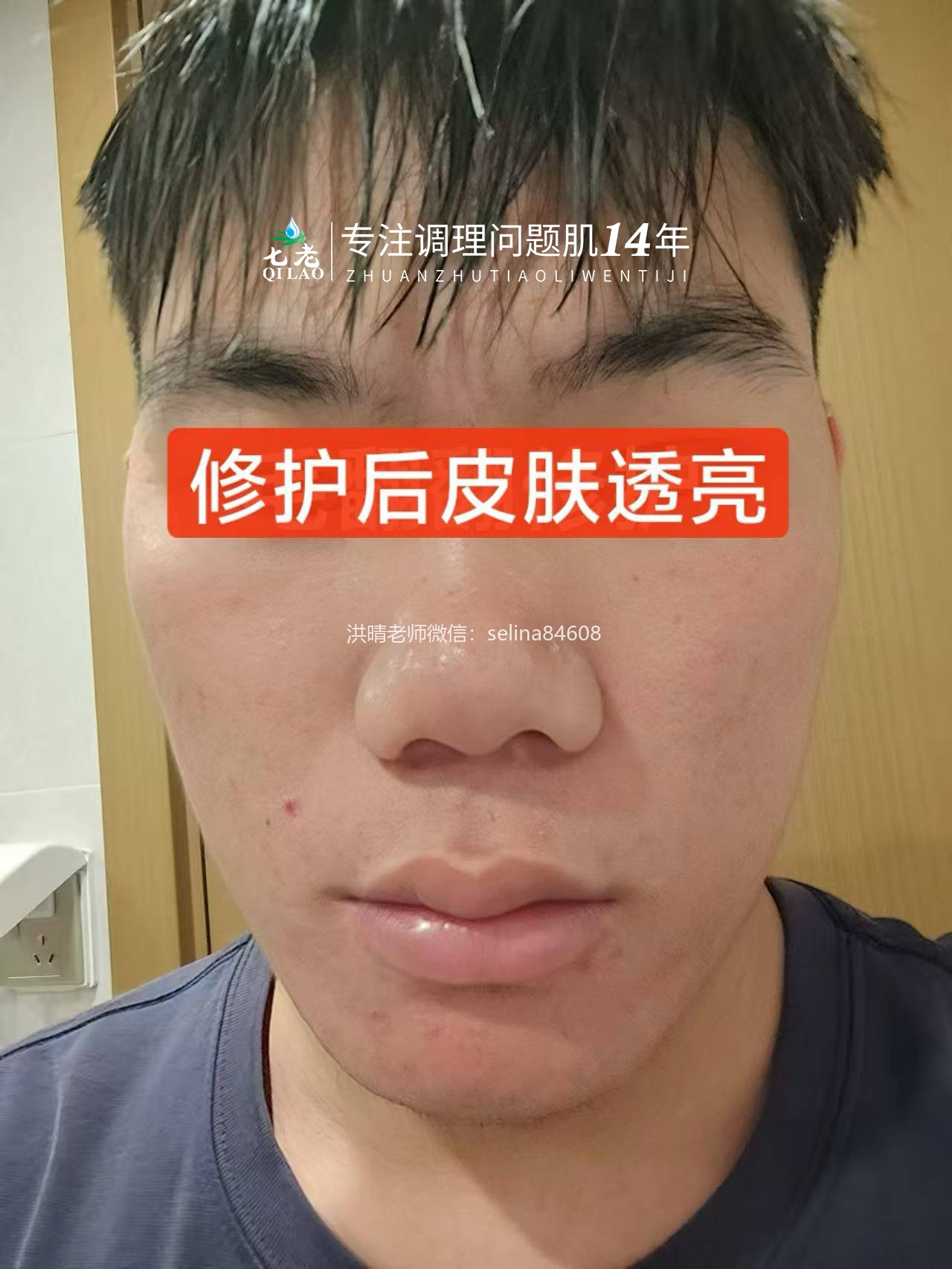 七老玫瑰痤疮➕脂溢性皮炎修护案例