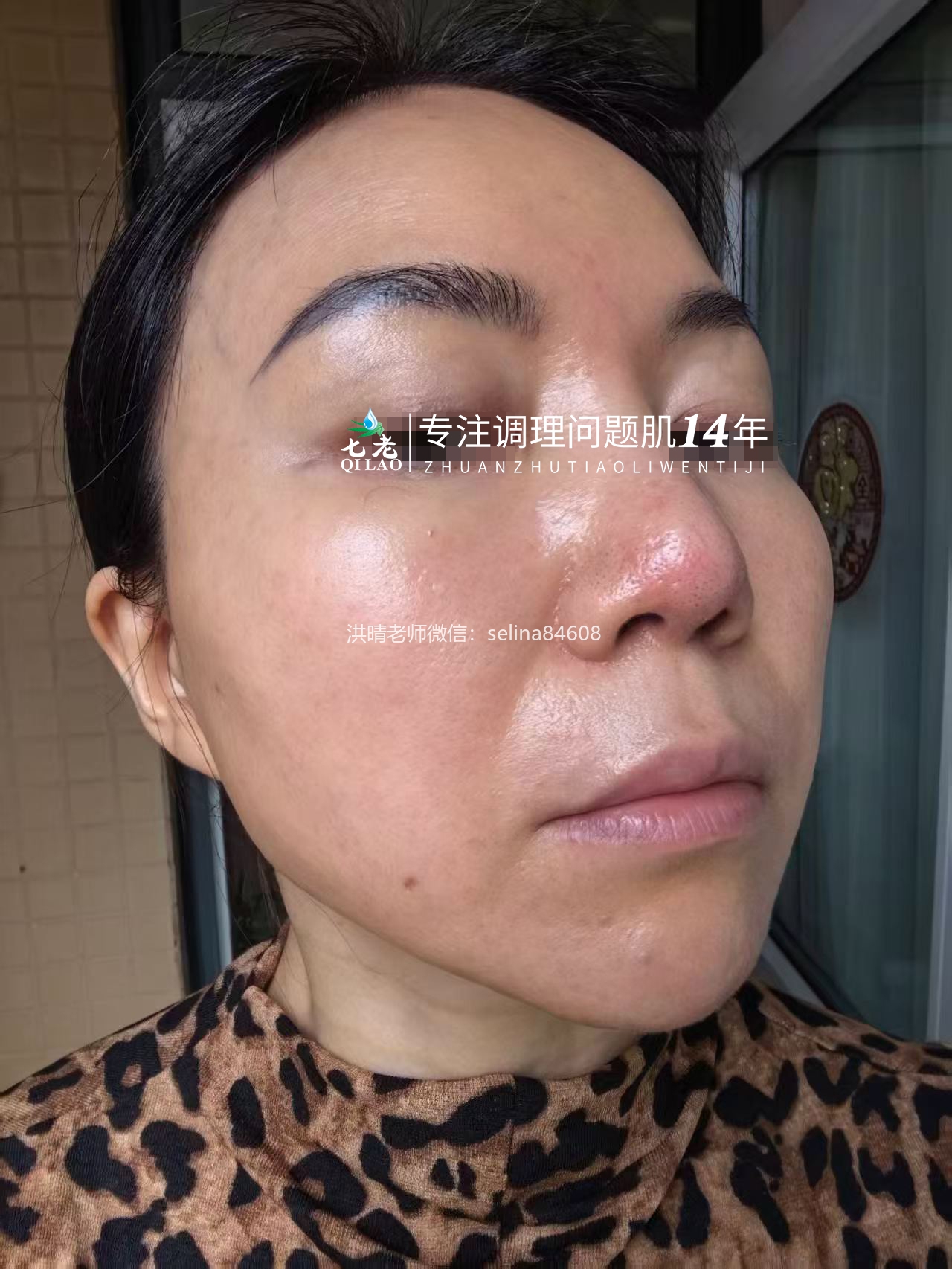 七老屏障受损油敏肌玫瑰痤疮修护案例
