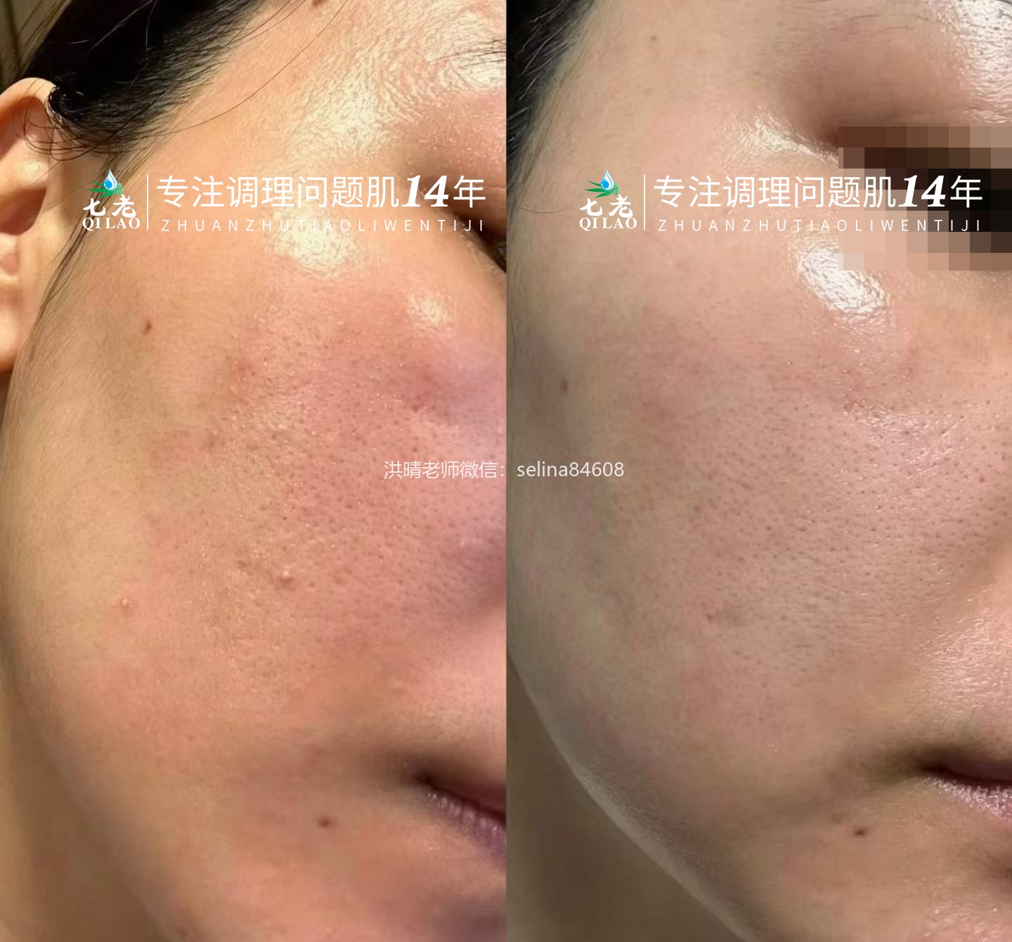 七老油敏疹子修护案例好评反馈