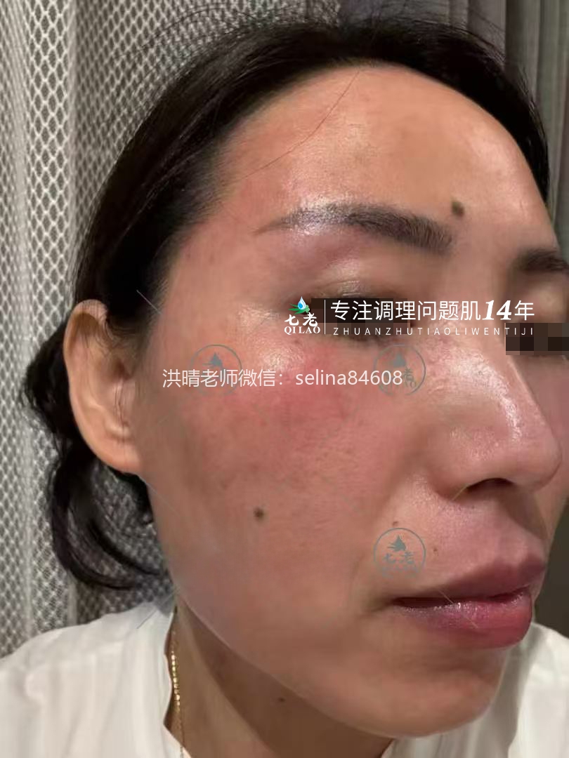 七老激素脸发红发烫修护案例