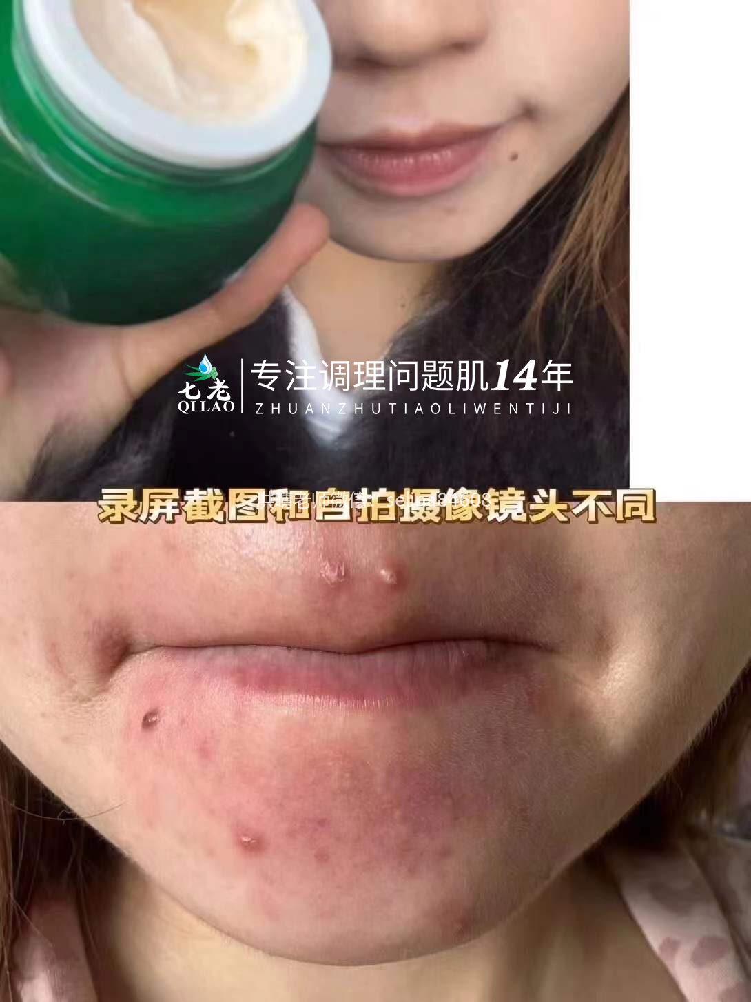七老激素脸➕脂皮修护案例