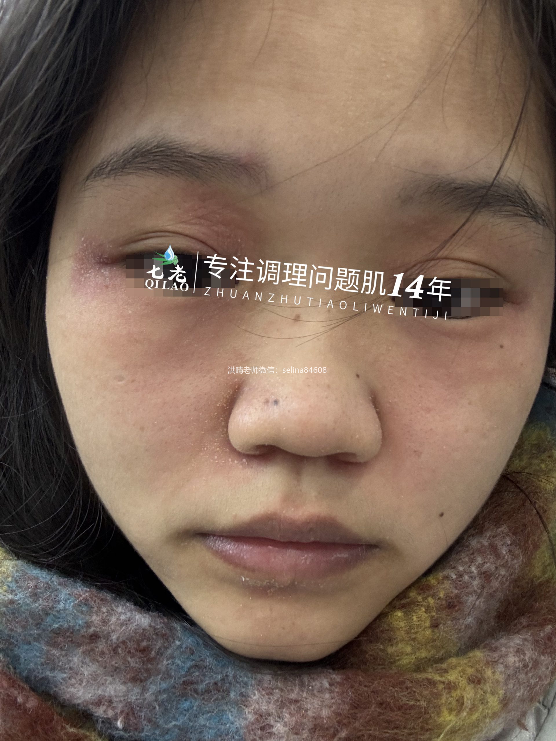 七老脂溢性皮炎修护案例