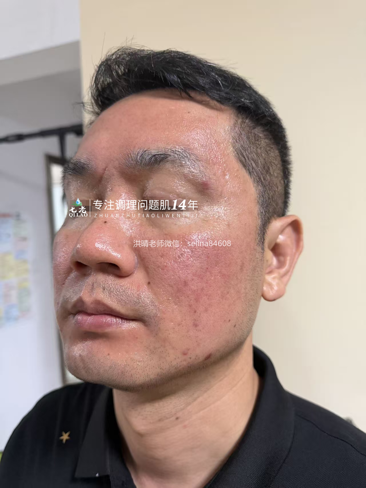 七老十年顽固痘痘肌修护案例