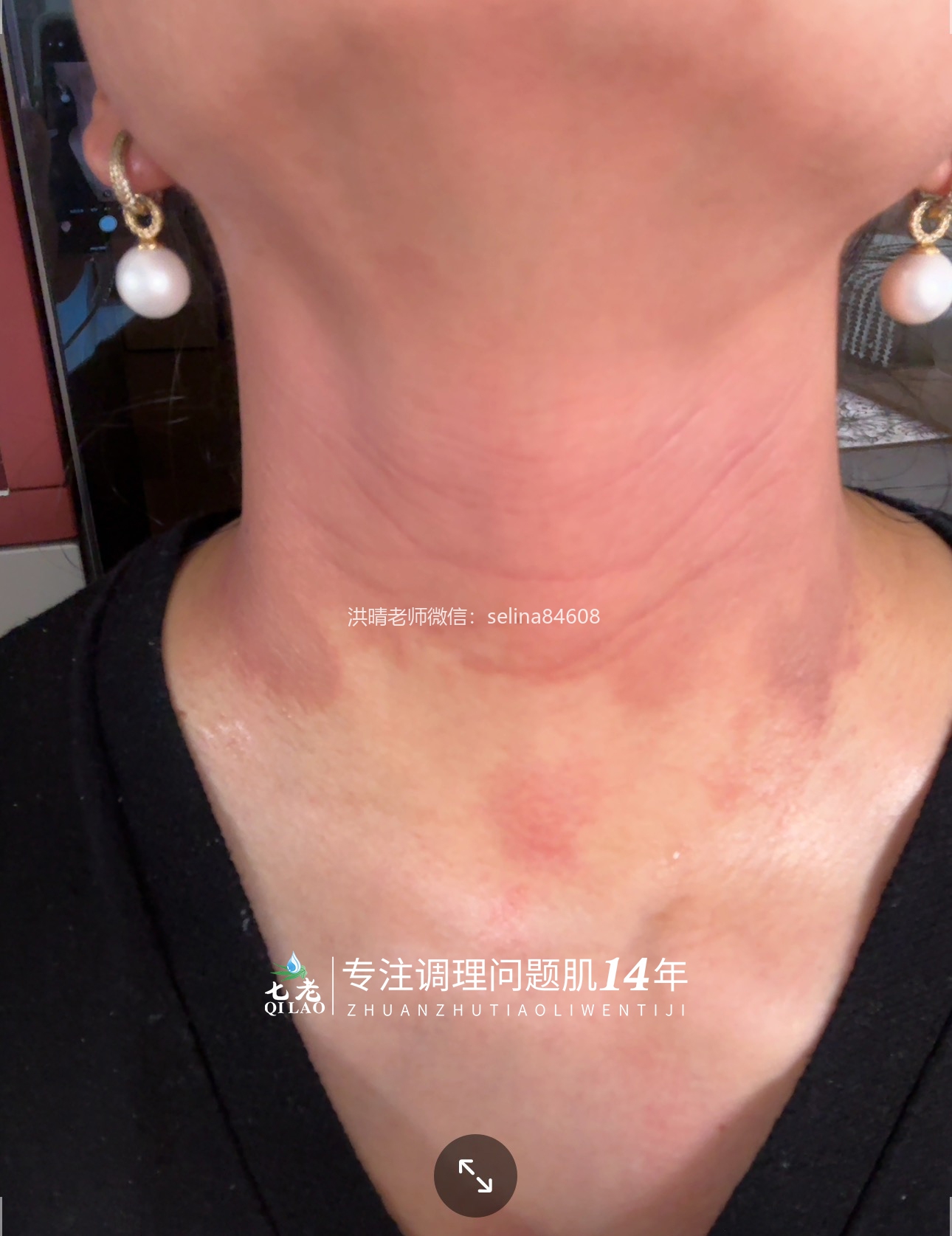 七老激素脸修护案例→全脸脖子红肿痒疹子爆皮