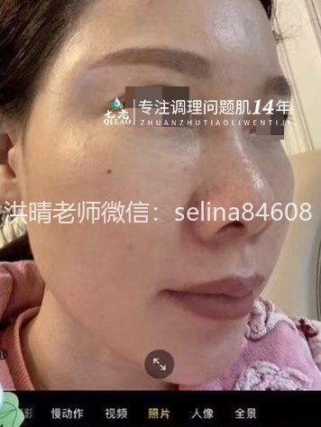 七老玫瑰痤疮正向案例反馈