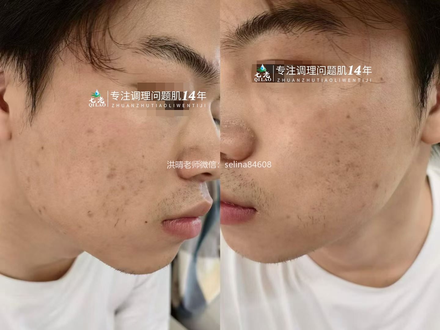 七老青春痘修护案例