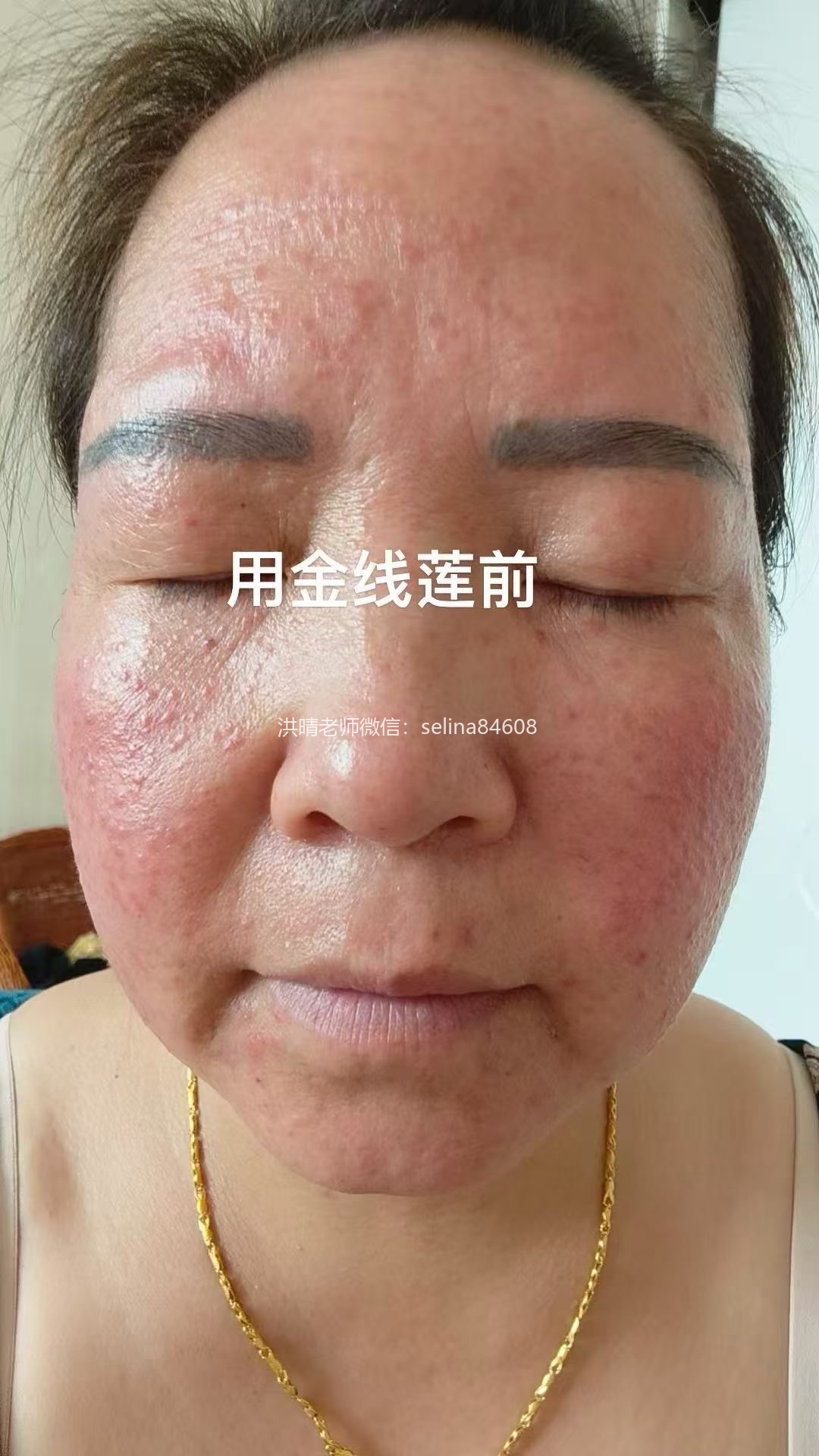七老玫瑰痤疮用新品金线莲系列内测反馈