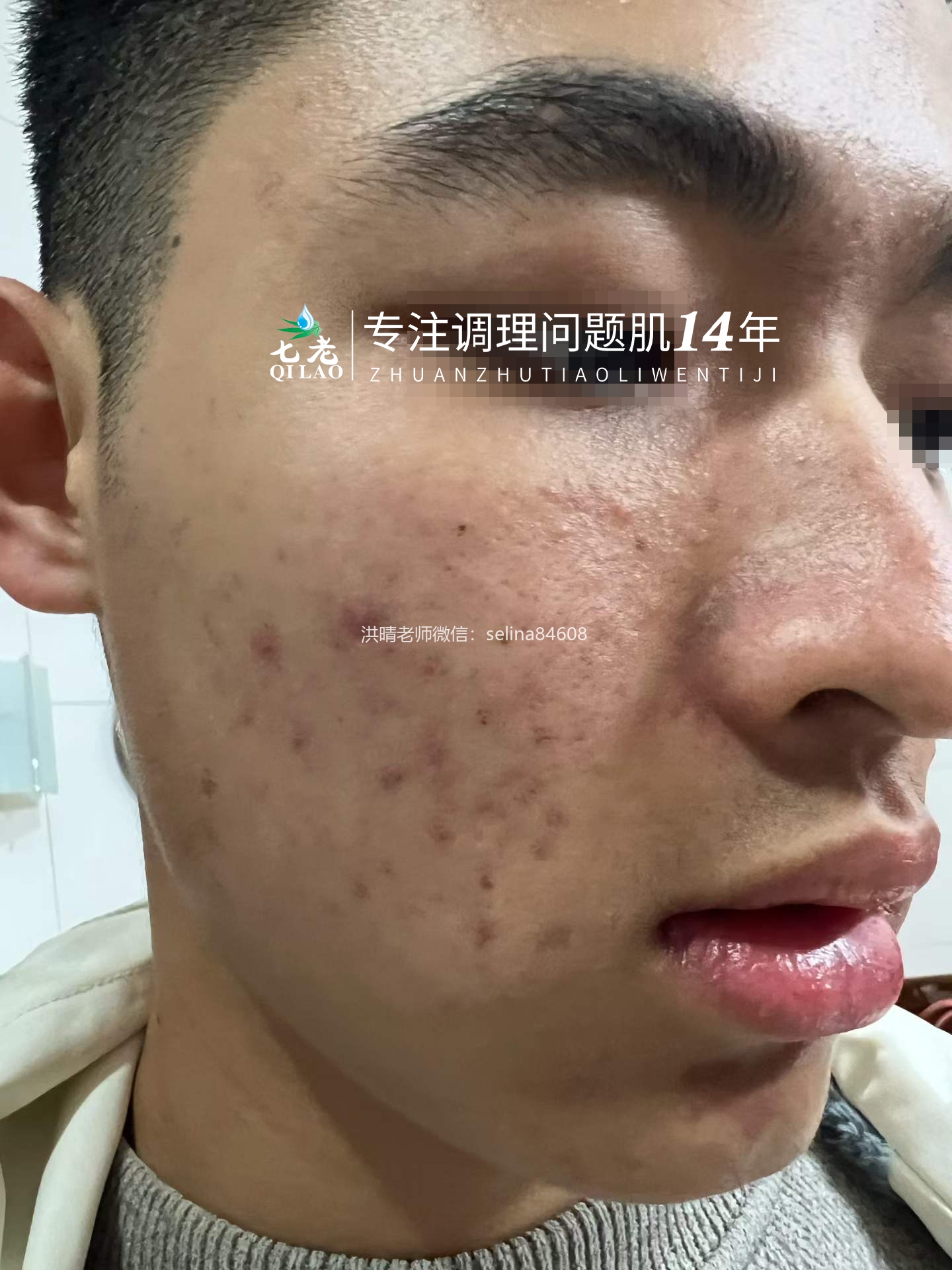 七老青春痘修护调理案例