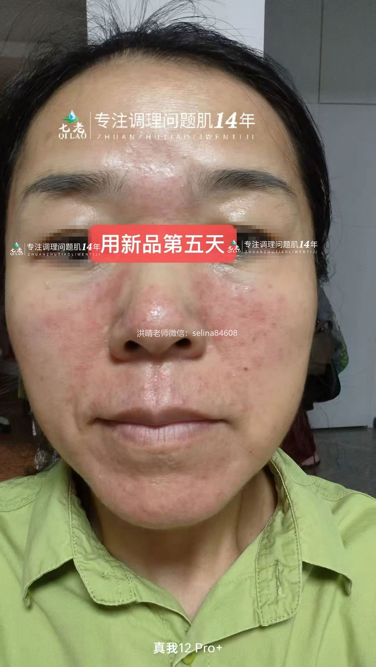 七老新品金线莲脂溢性皮炎五天反馈对比