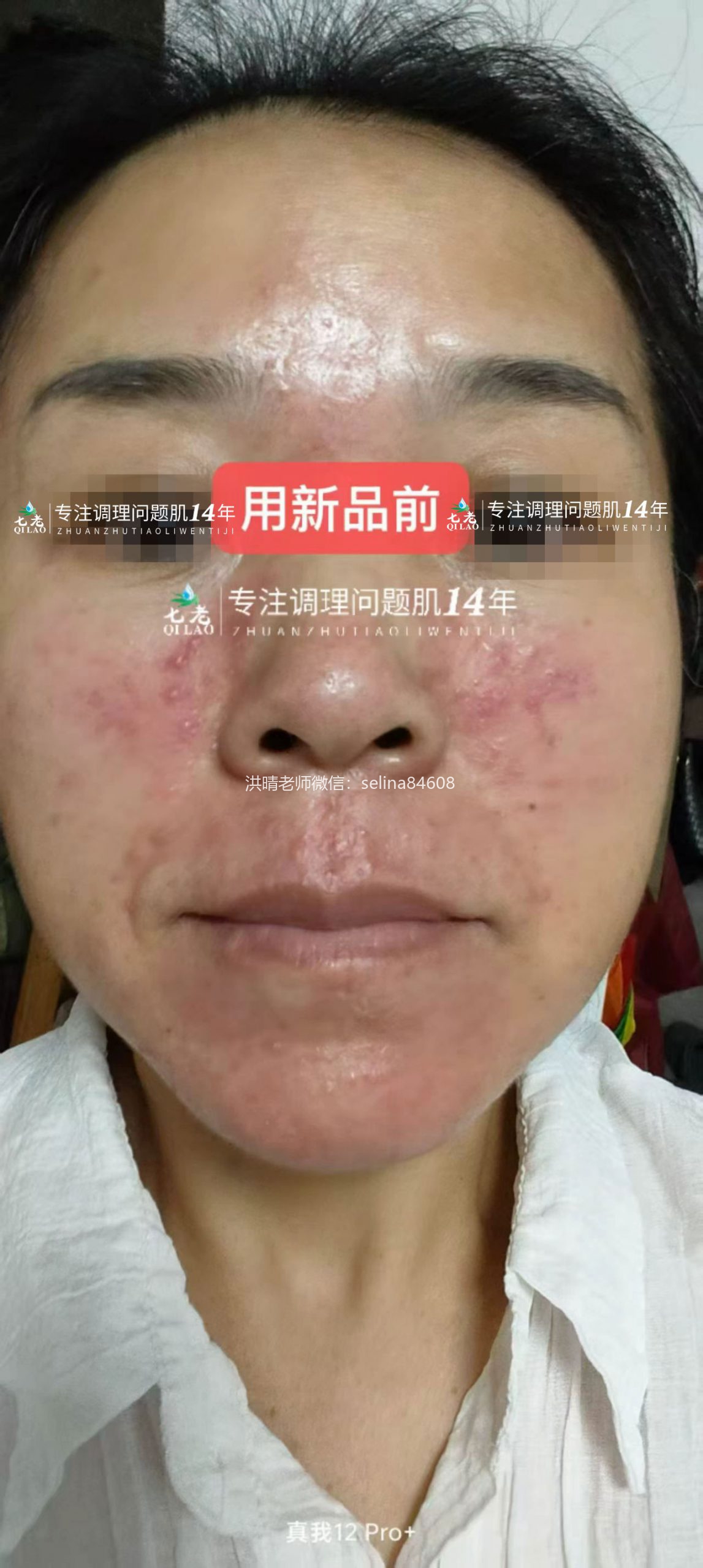 七老新品金线莲脂溢性皮炎五天反馈对比