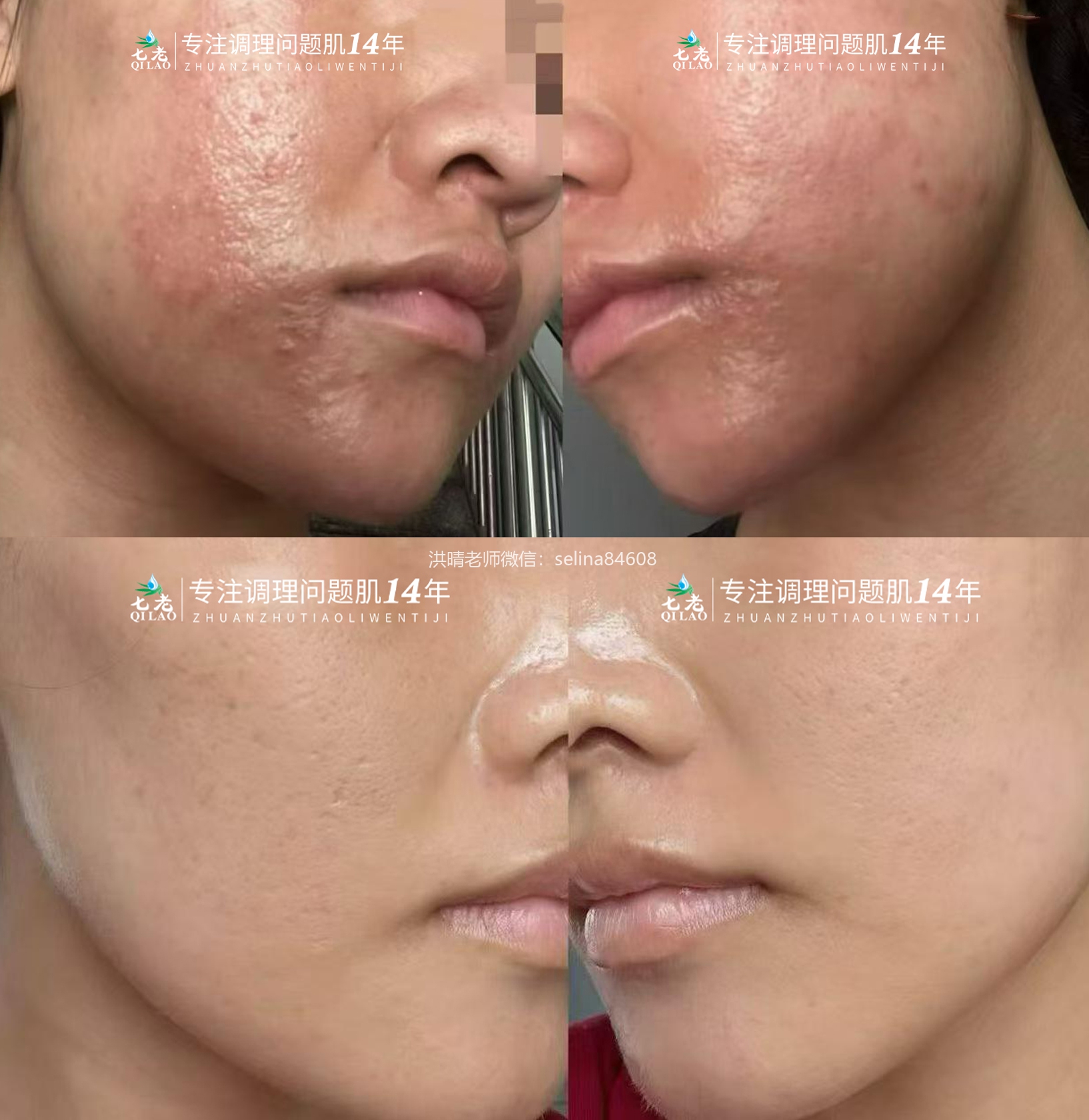 七老激素脸修护案例反馈