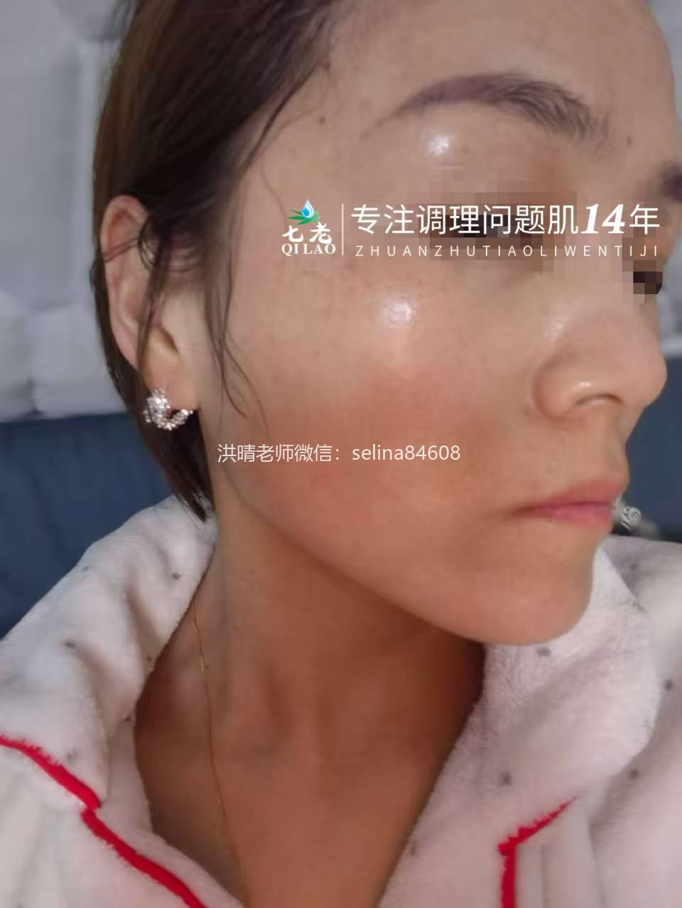 七老反复过敏红痒疹子修护案例