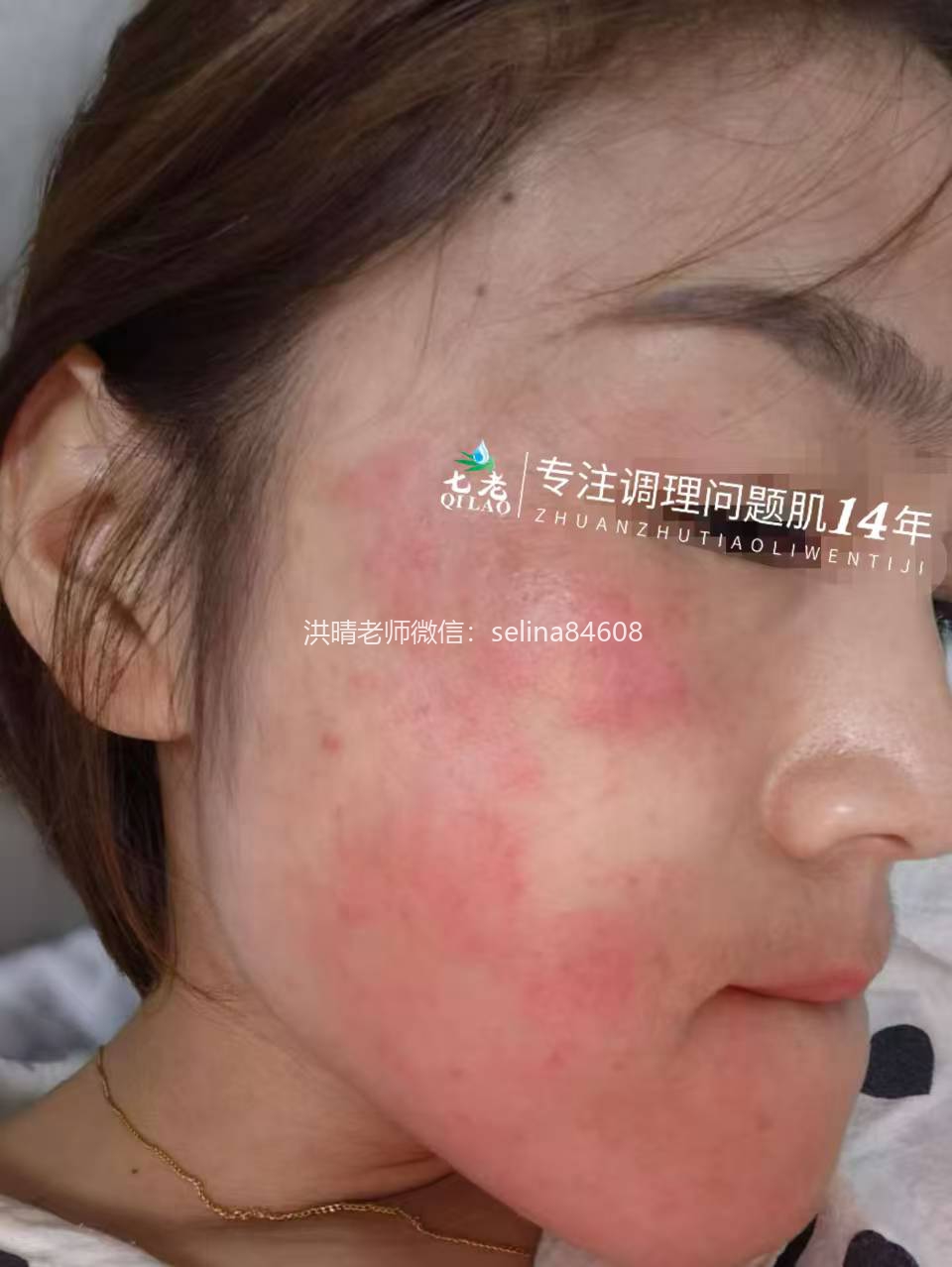 七老反复过敏红痒疹子修护案例