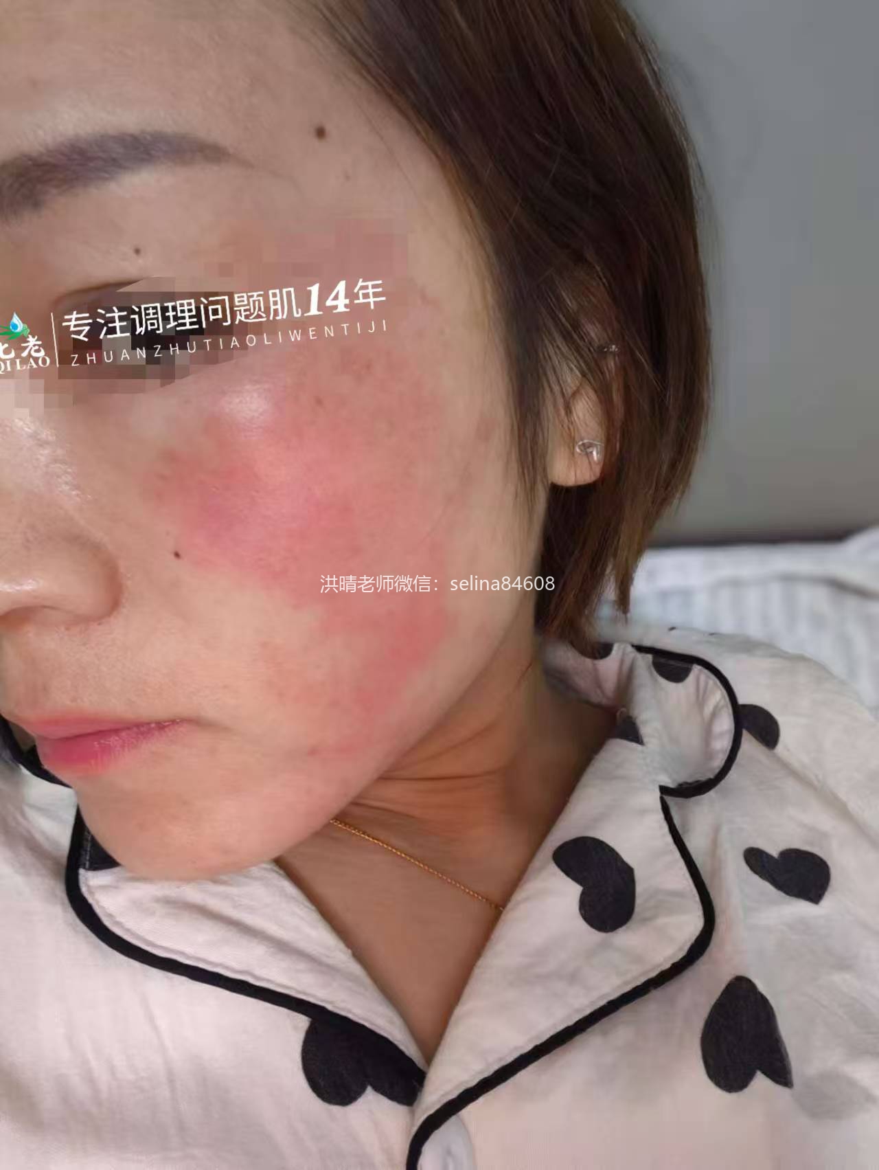 七老反复过敏红痒疹子修护案例